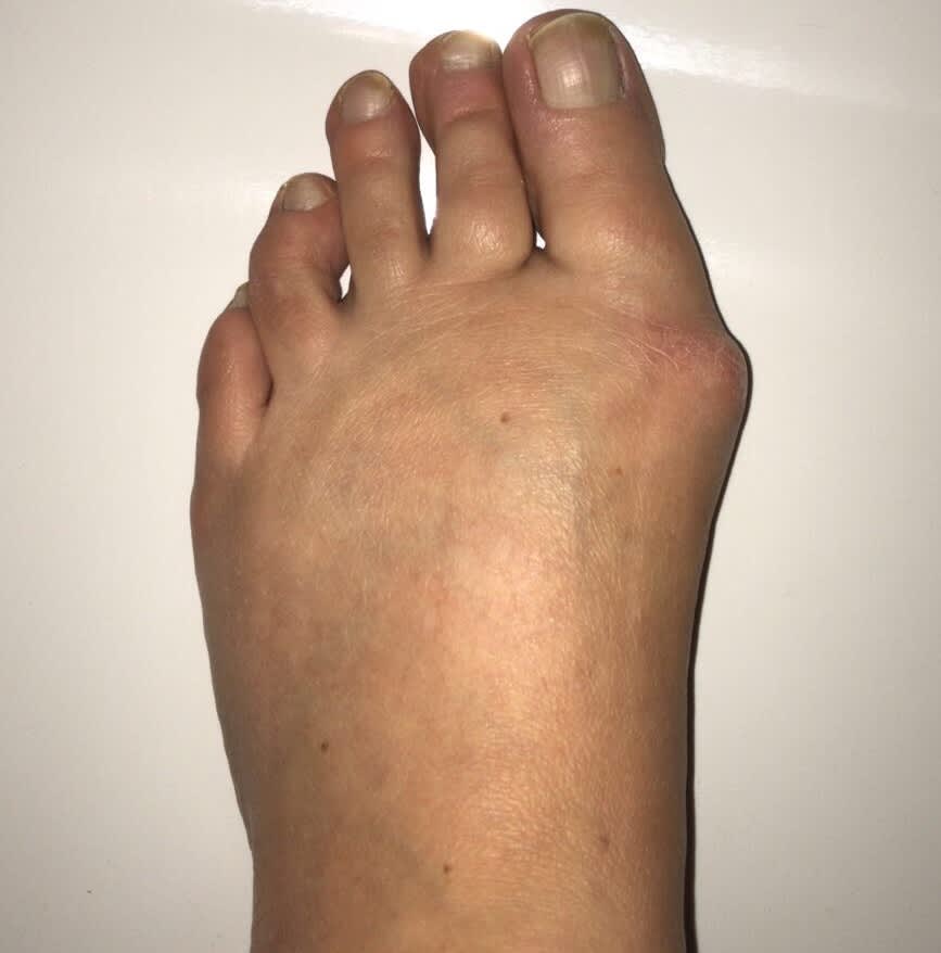 Picture of the left foot with a noticeable angular bunion on the side of the foot just below the big toe. The big toe is turned outwards.