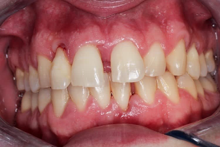 In the image is a mouth with and active perodontitis, where connective tissues and bone that keep the teeth attached are destroyed, making the teeth wobbly. Image: The Finnish Dental Association.