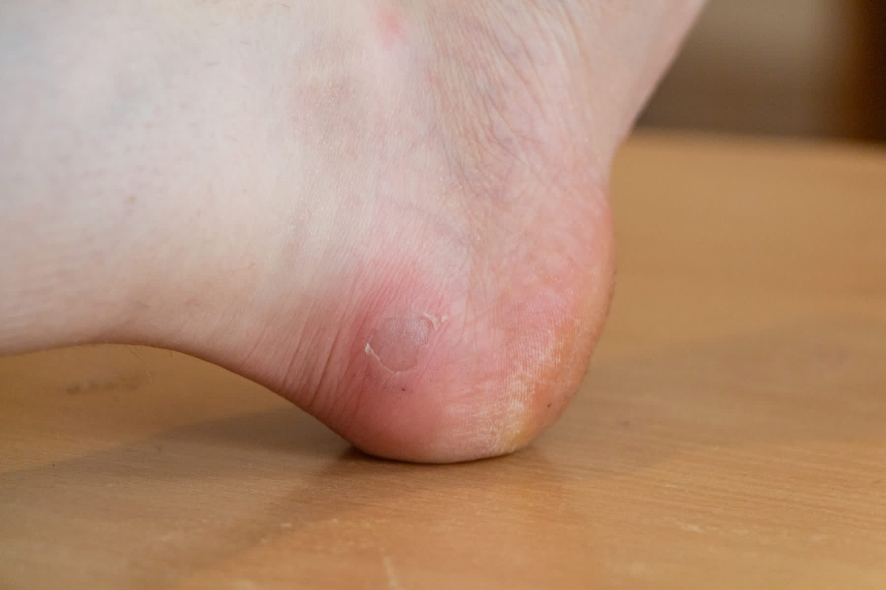 In the image is a blister on the side of the heel. There is redness around the blister.