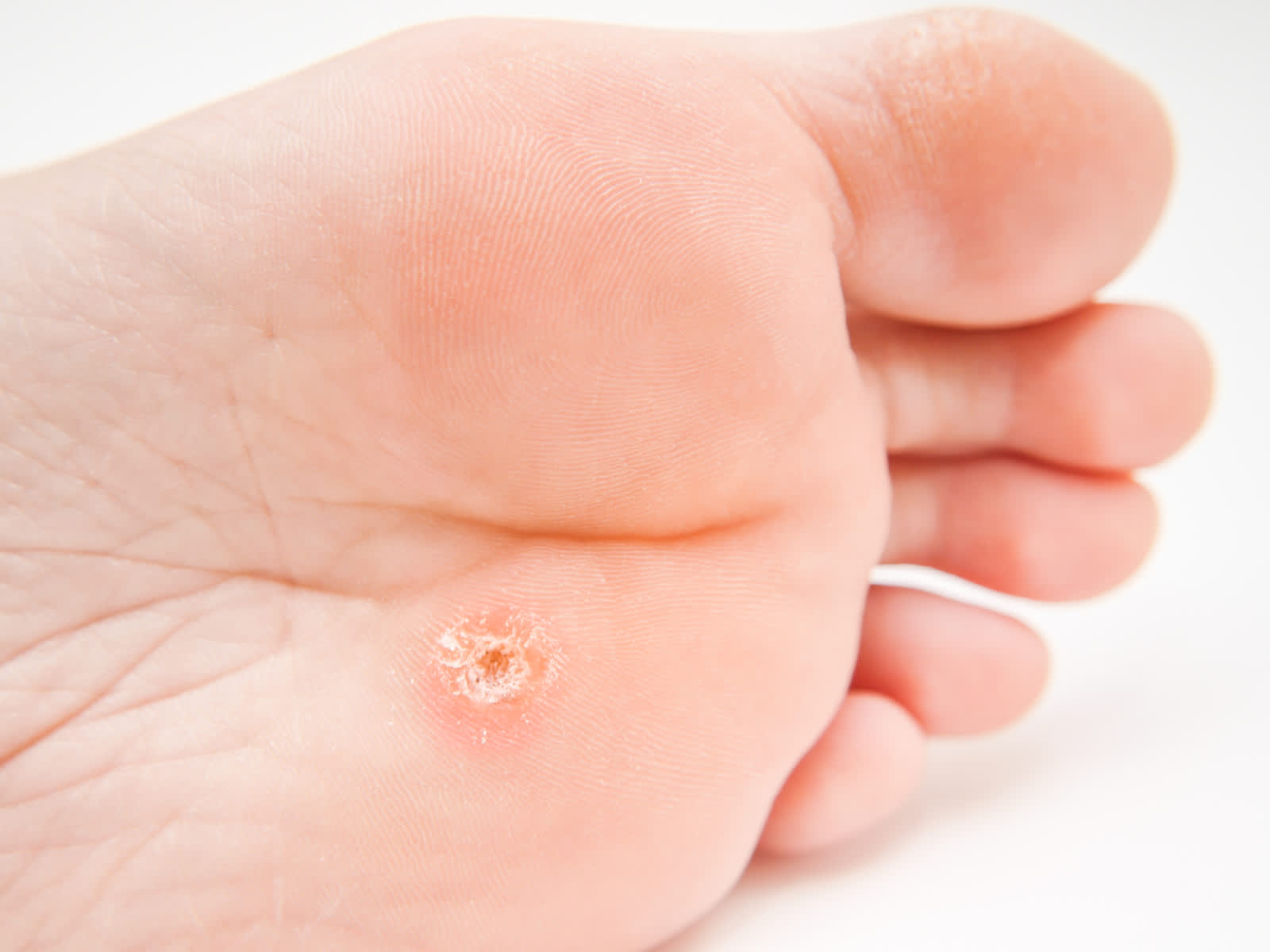 In the image, there is a sole of a foot with a wart in the middle of the forefoot.