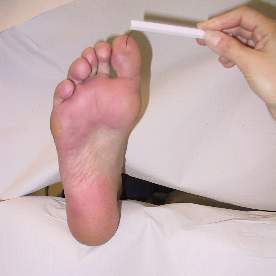 In the image is a sensory testing with a monofilament, a thin flexible wire, on the sole of the foot. Protective sensation of the feet is tested at least from three points i.e. 1st and 5th toe and ball of the foot