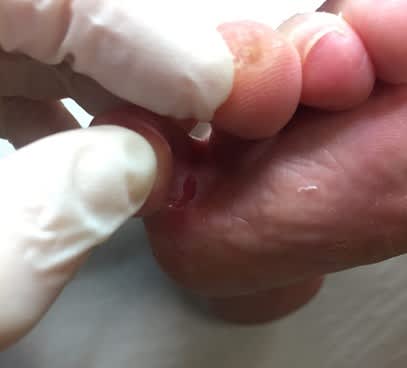 Bilden visar höger fot med ett ruv mellan fjärde och femte tån med ett mousserat sår.