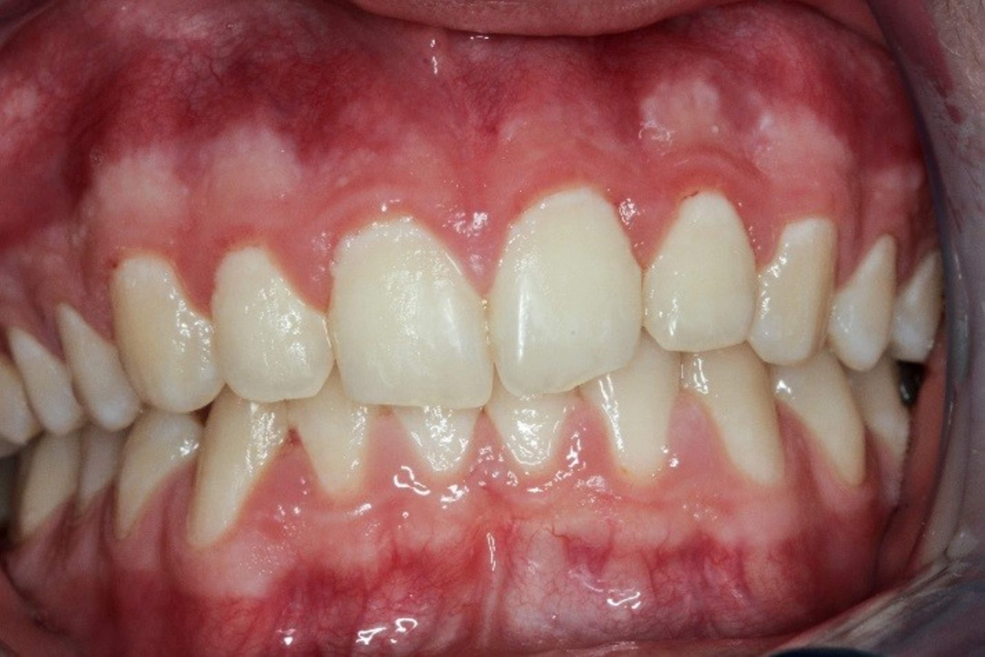 Kuvassa on suu, jossa on vaikea ientulehdus eli bakteeripeitteiden aiheuttama pehmytkudoksen tulehdus koko suussa. Kuva: Suomen Hammaslääkäriliitto.