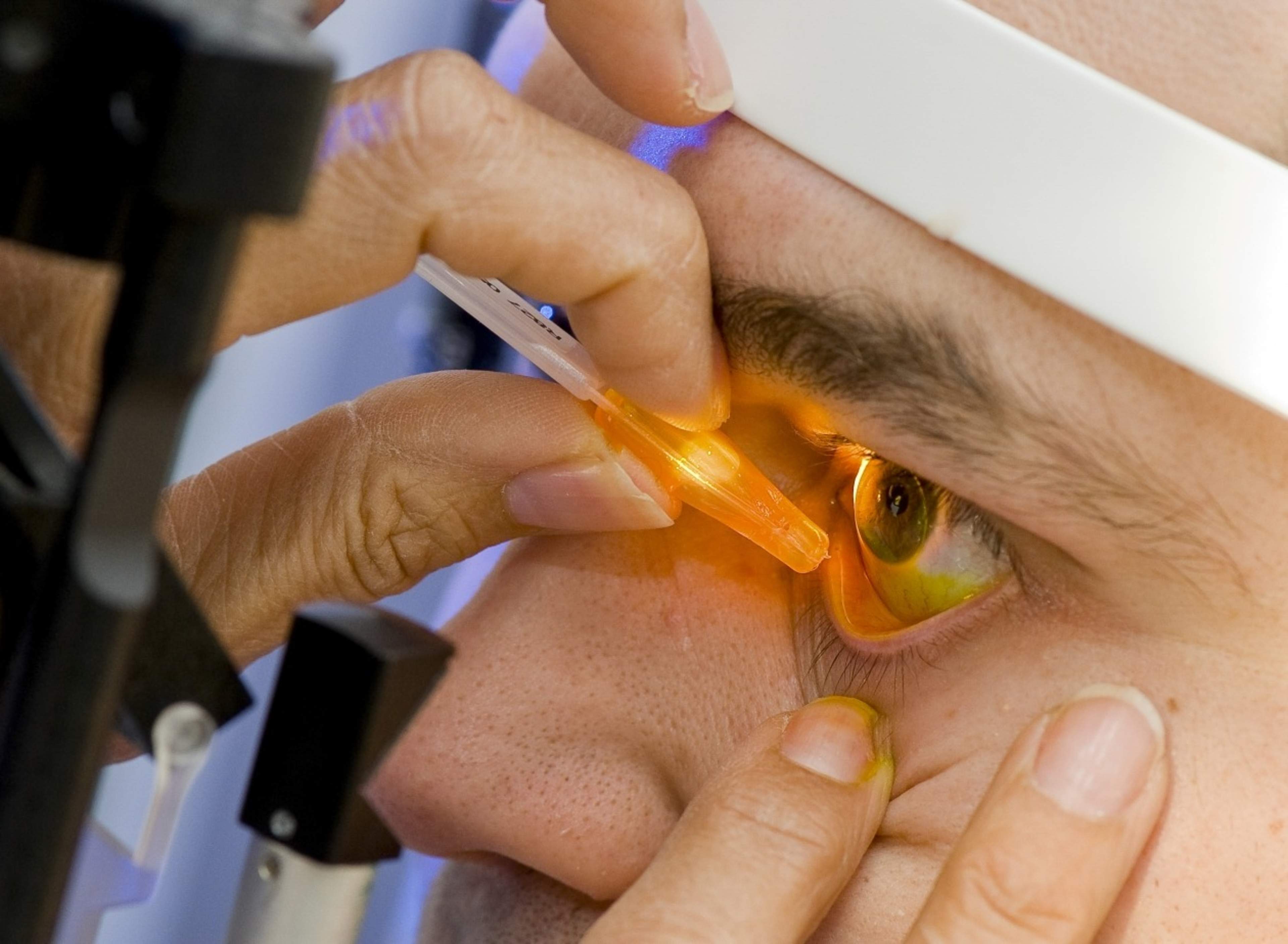 Silmän pinta voidaan värjätä keltaisella fluoreseiini-värillä ja tarkastella kyynelnesteen hajoamisnopeutta ja mahdollisia pintavaurioita sinivalon avulla