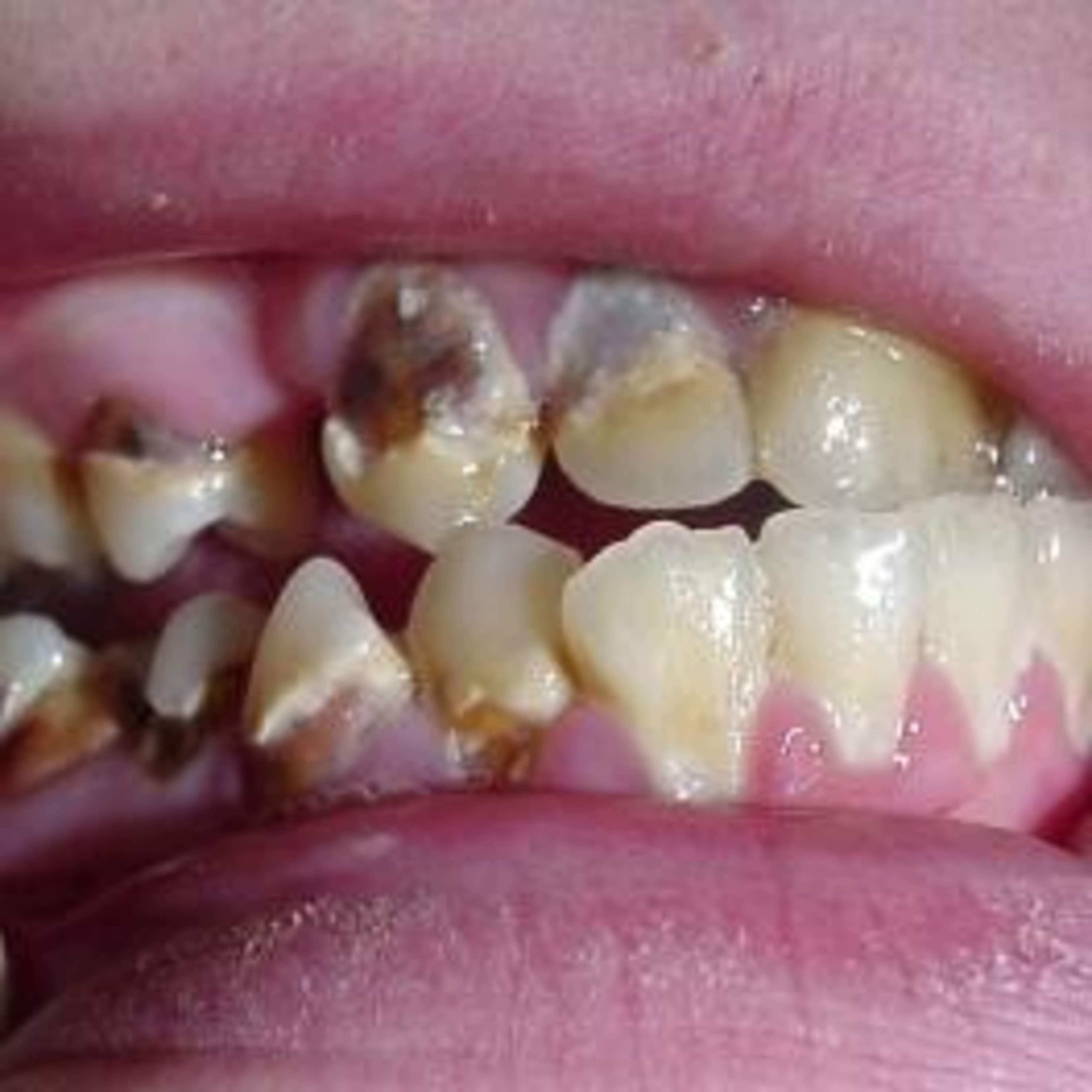Kuvassa suu, jossa vaikeasti reikiintyneitä hampaita sekä ylhäällä että alhaalla. Kuva: Suomen Hammaslääkäriliitto