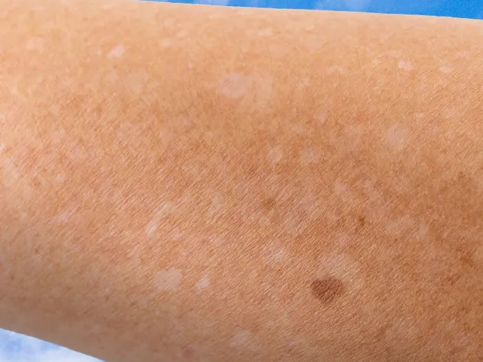 Närbild på en arm med hypopigmentering, mot en blå bakgrund.