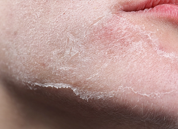 Närbild på en persons ansikte som visar torr och fjällande hud på kinden. Personen har ljus hud och läpparna är delvis synliga. Bakgrunden är suddig.