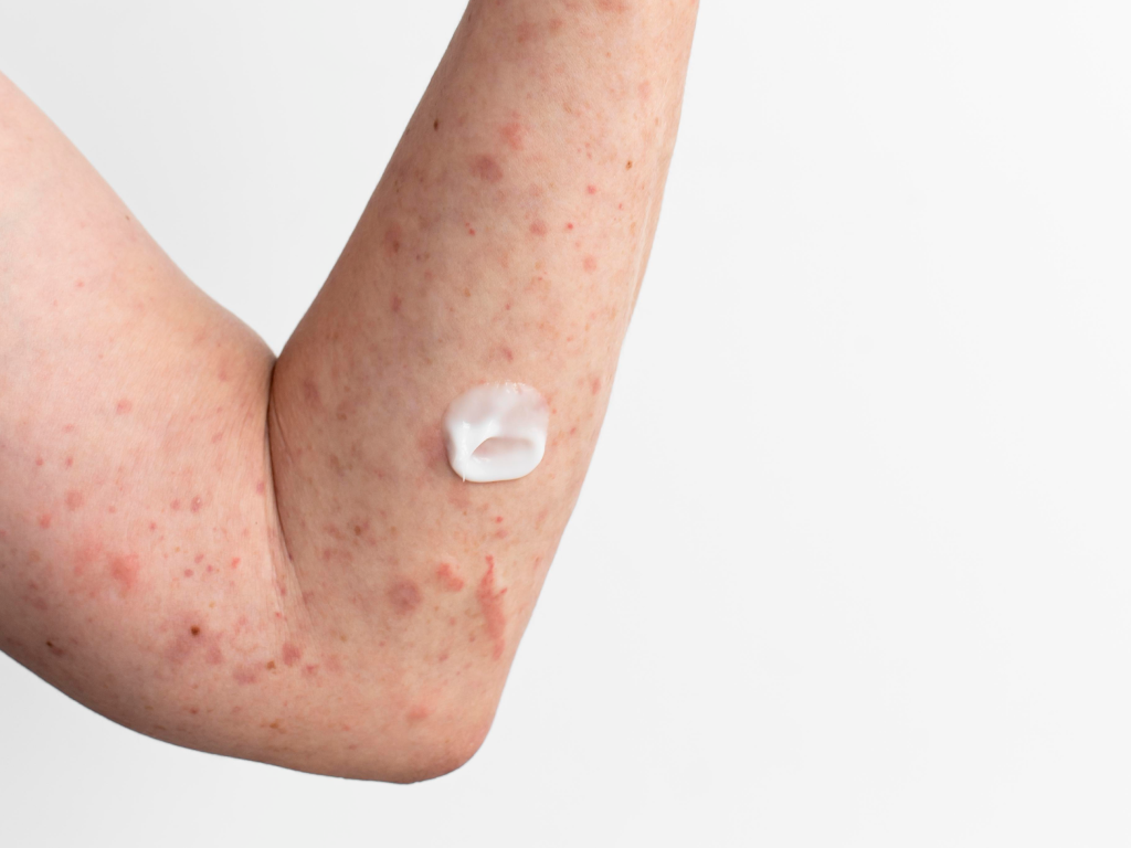 Atopisk eksem – farmakonomens råd til lindring og pleje