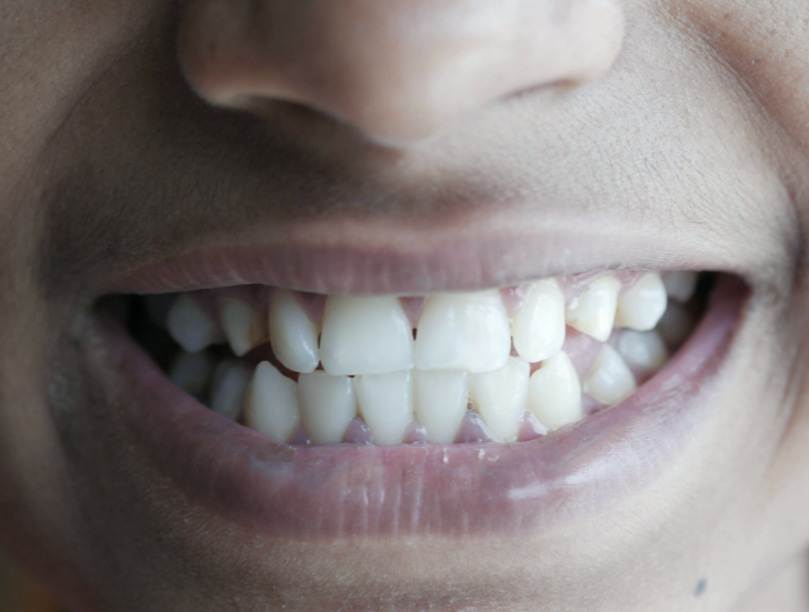 Tænderskæren - symptomer og behandling