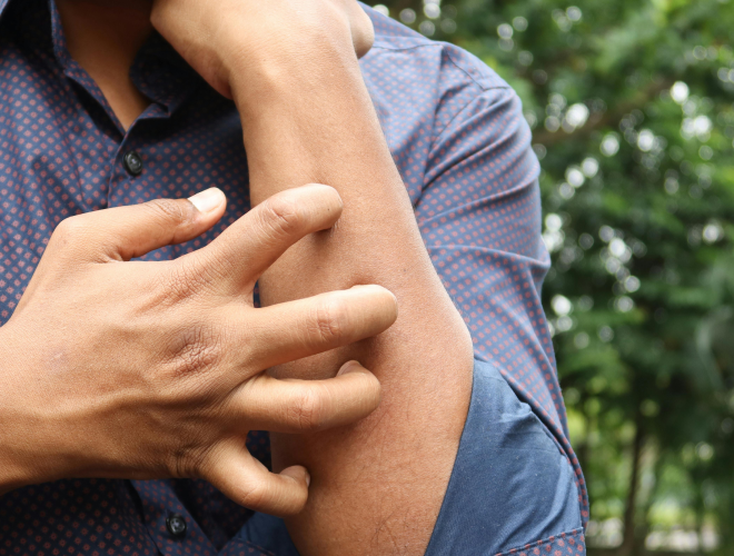 Nældefeber: symptomer, årsager og behandling