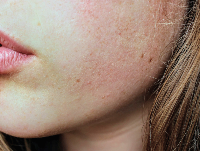 Rosacea - symptomer og behandling
