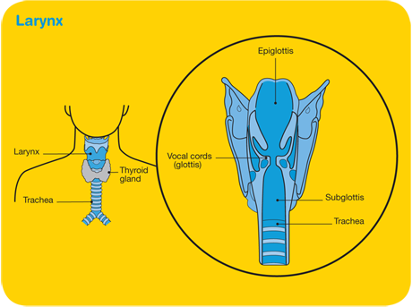 mater-Laryngeal-cancer-diagram
