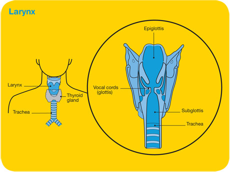 mater-Laryngeal-cancer-diagram