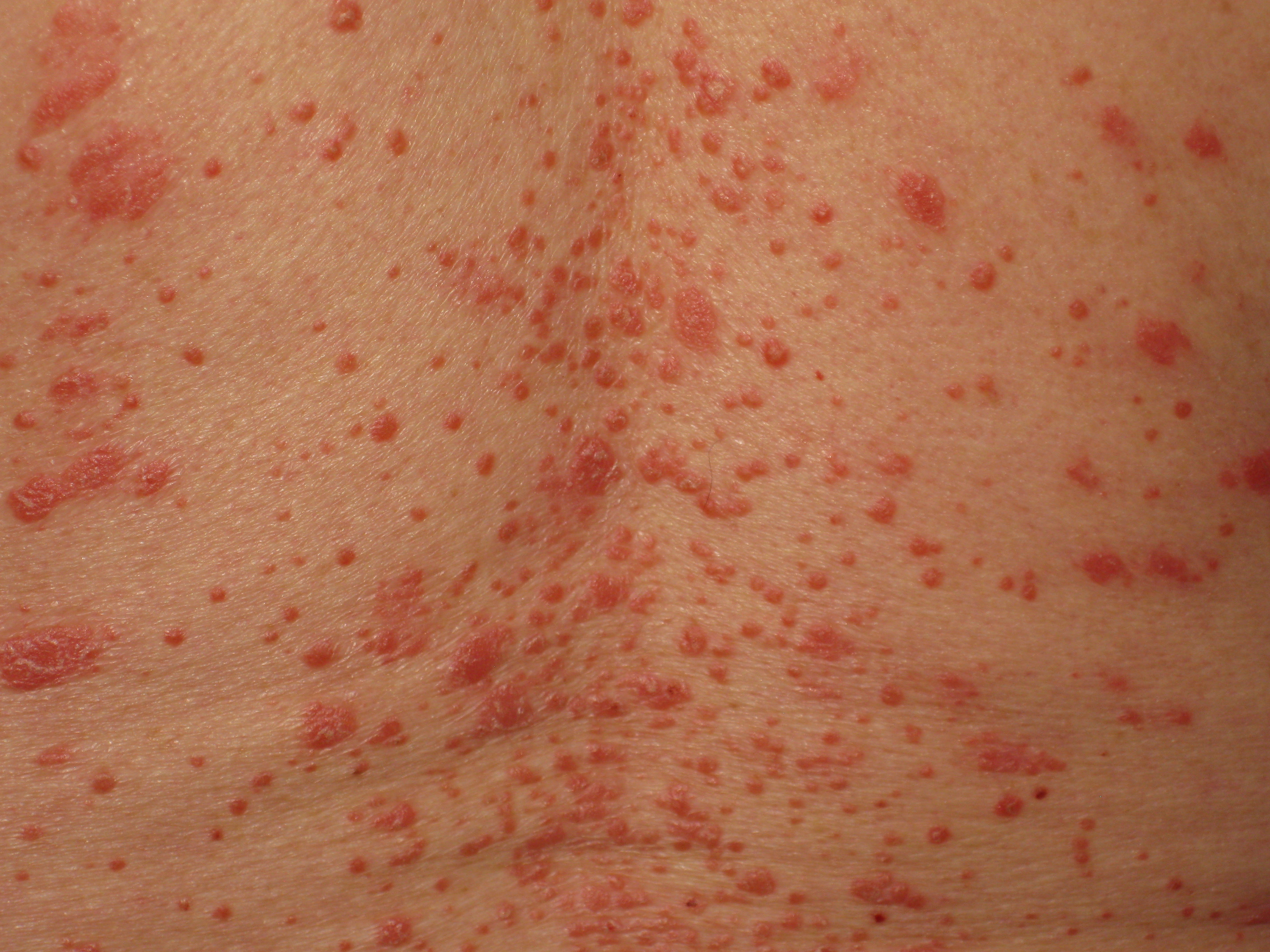 Bild på guttat psoriasis