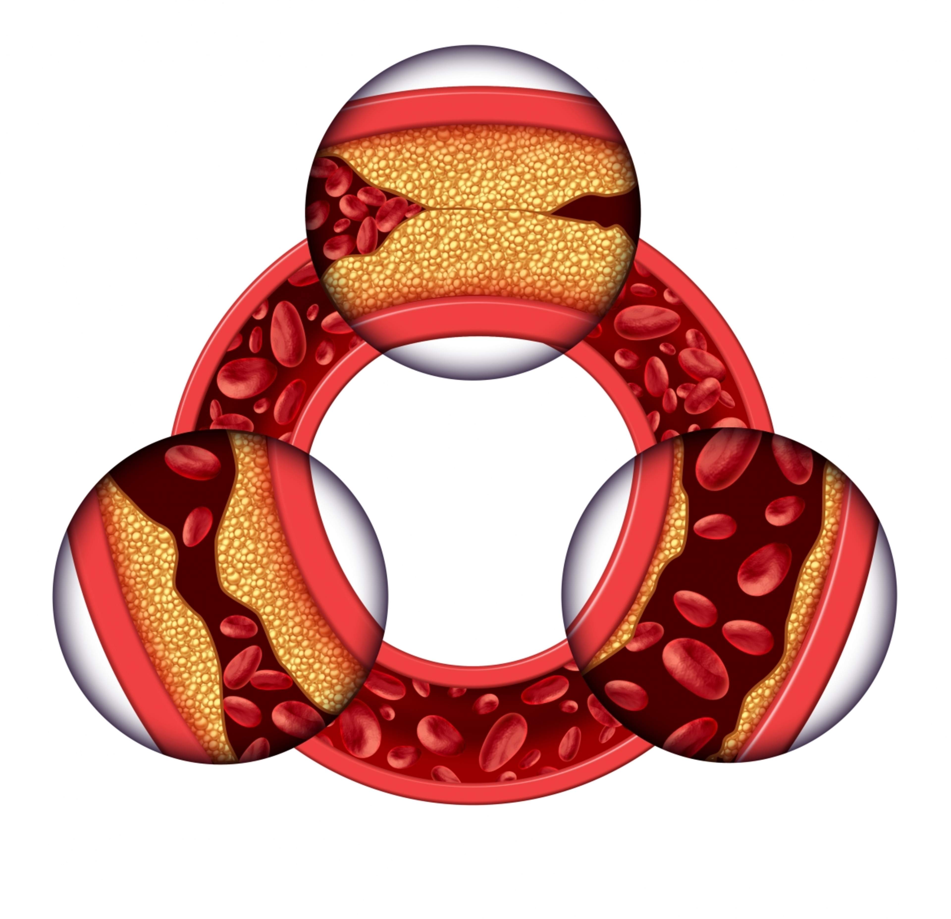 In the picture on the right, there is a healthy blood vessel; on the left, excess cholesterol has started to attach to the vessel wall, and at the top of the image, the vessel is completely blocked.