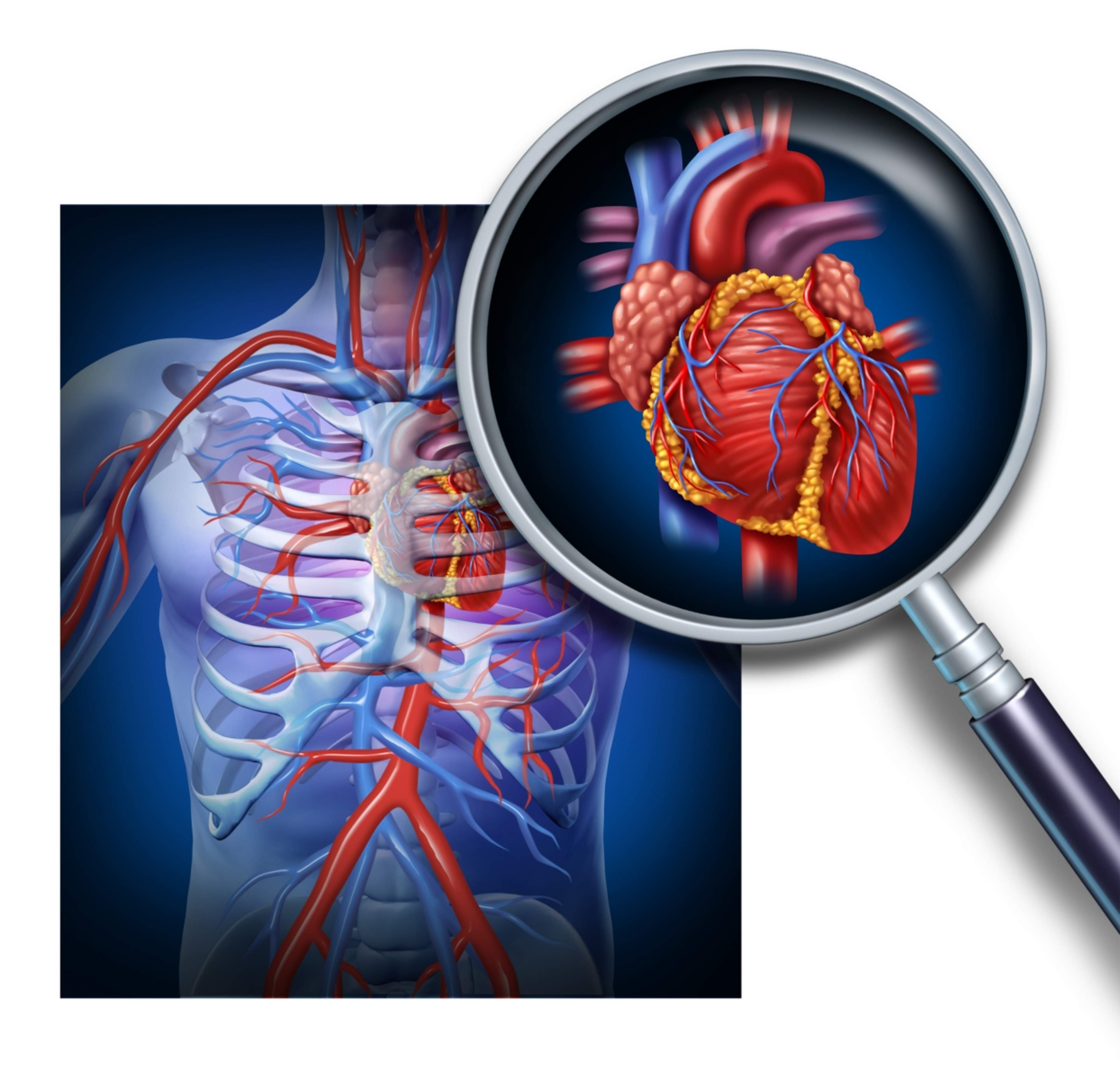 The picture shows the heart and its blood vessels, where excess cholesterol accumulates leading to the narrowing of the vessels and reduced oxygen supply to the heart, causing coronary artery disease.