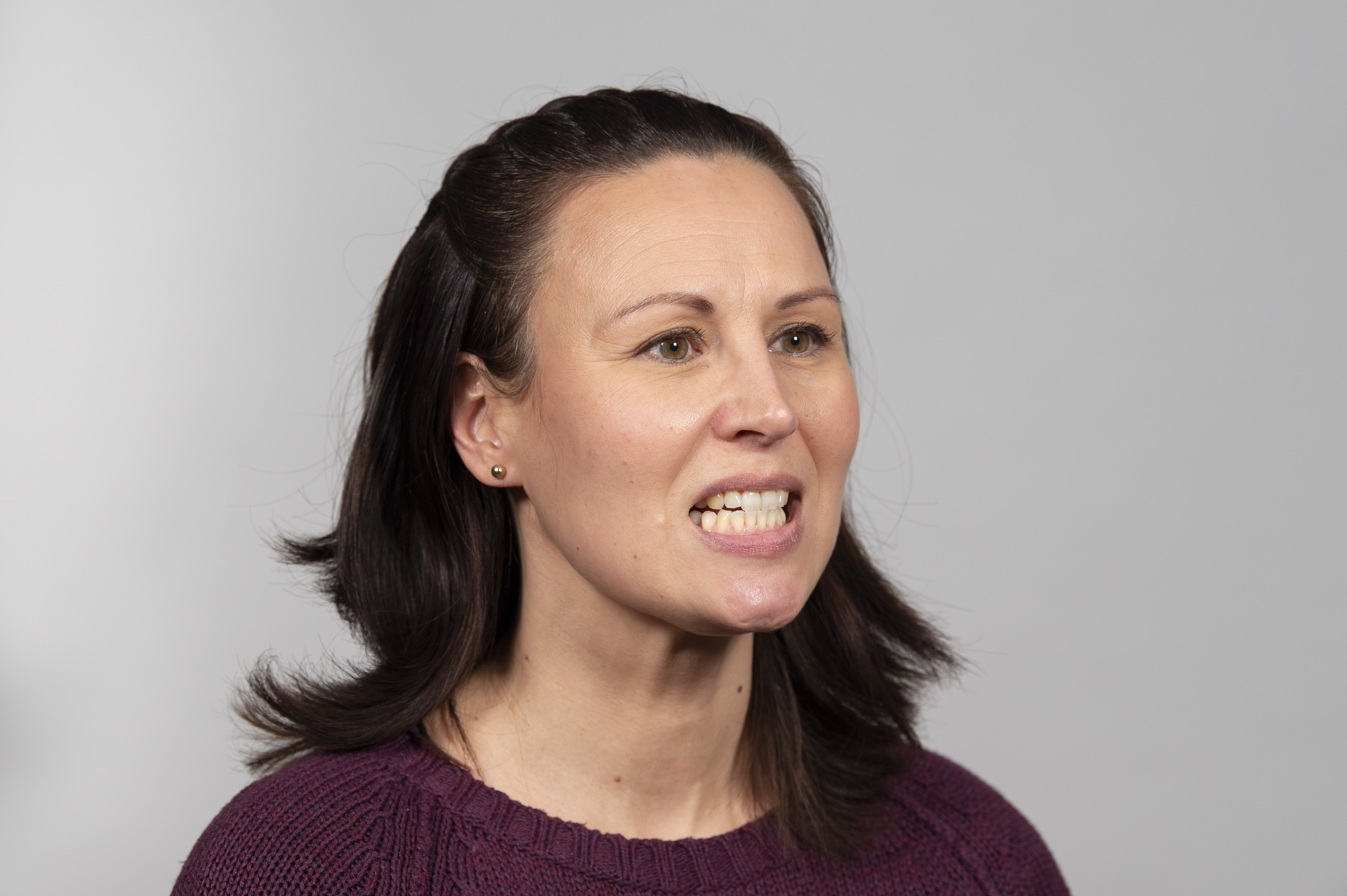 Nainen on työntänyt alaleukaa eteen ja sulkenut suu siten, että etuhampaiden kärjet ovat vastakkain.