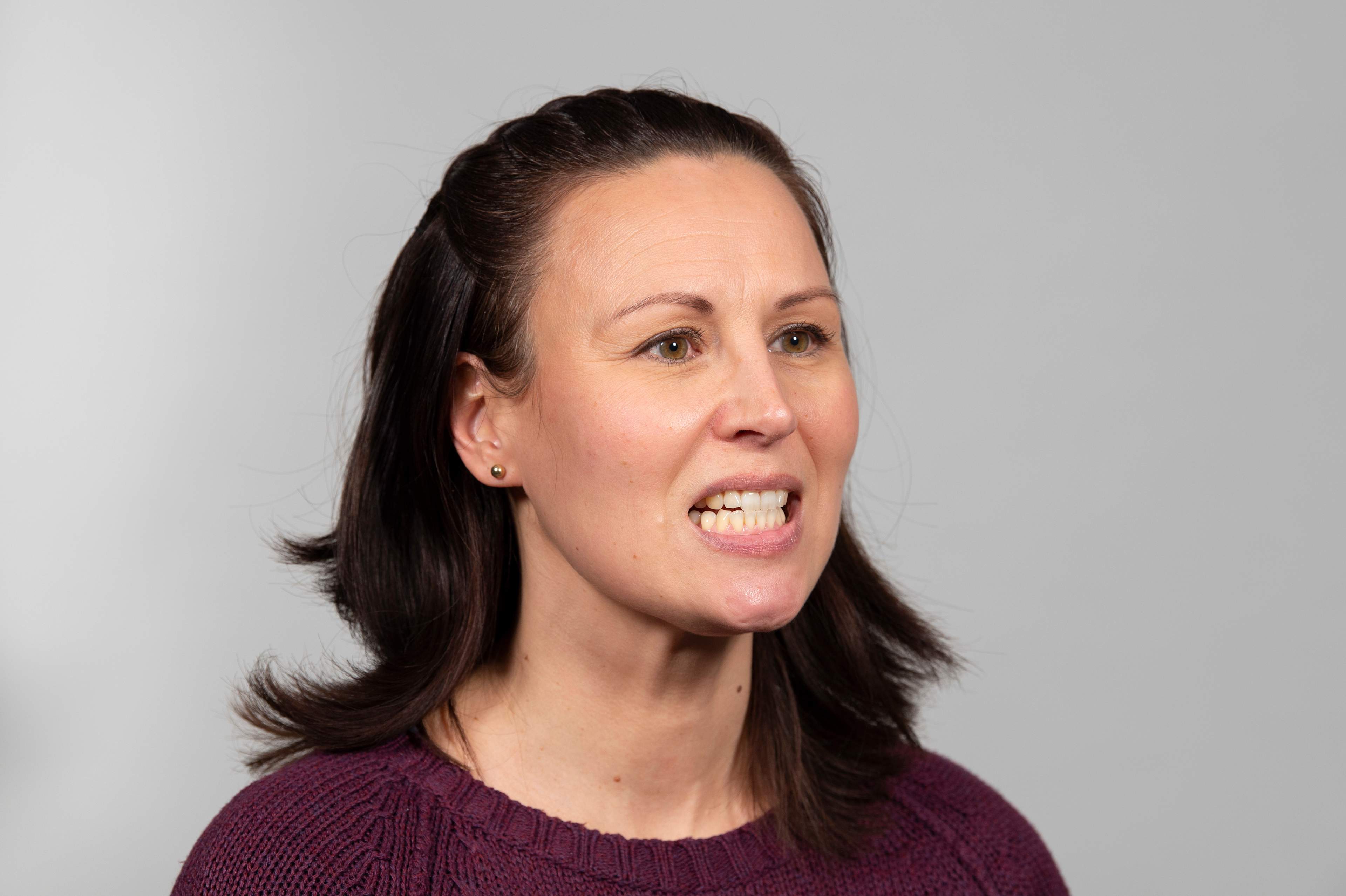 Kvinna har skjutit underkäken framåt och stängt munnen så att framtändernas spetsar möts.