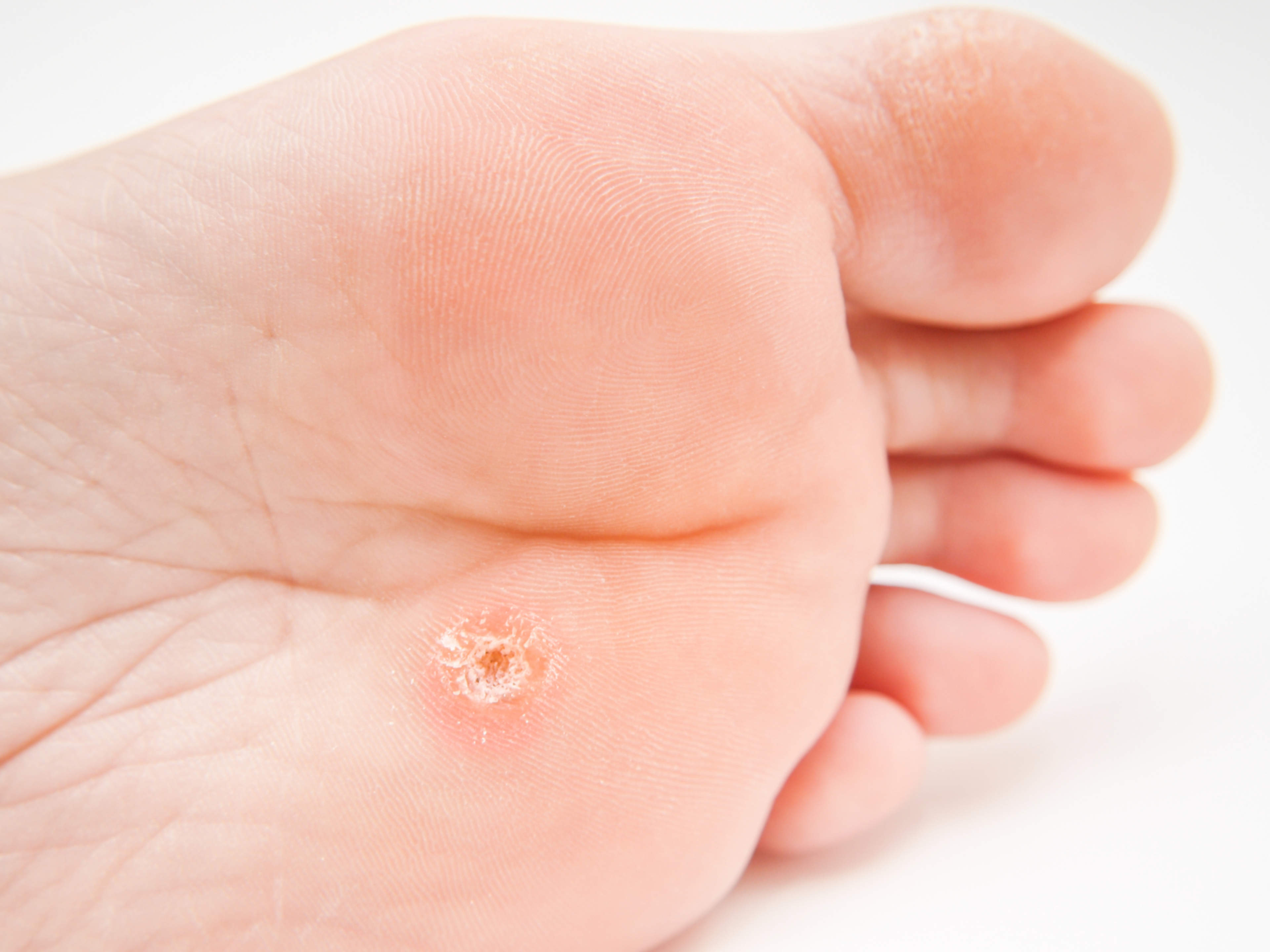 In the image, there is a sole of a foot with a wart in the middle of the forefoot.