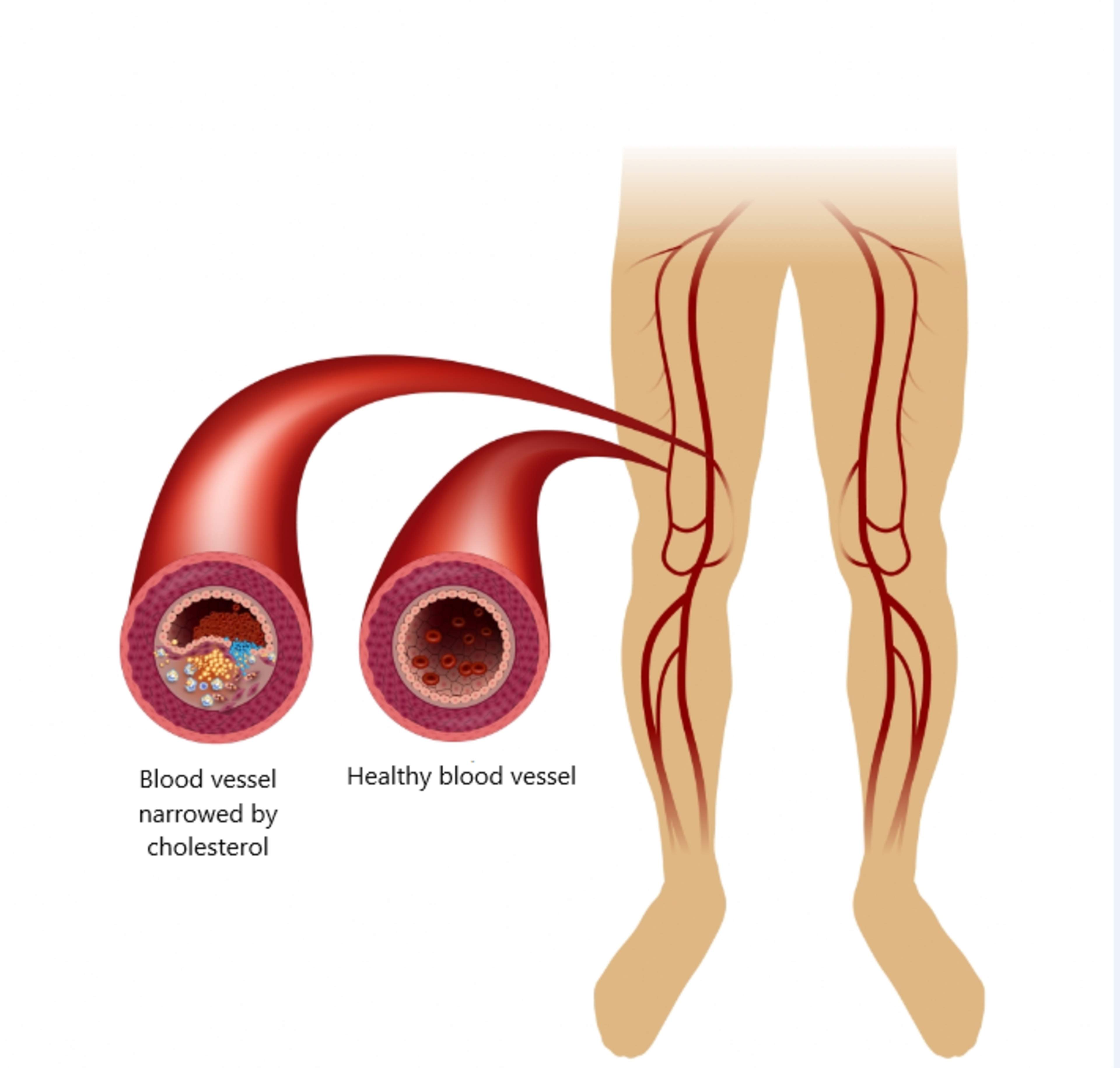 In the picture, there is a blood vessel narrowed by cholesterol and a healthy blood vessel.