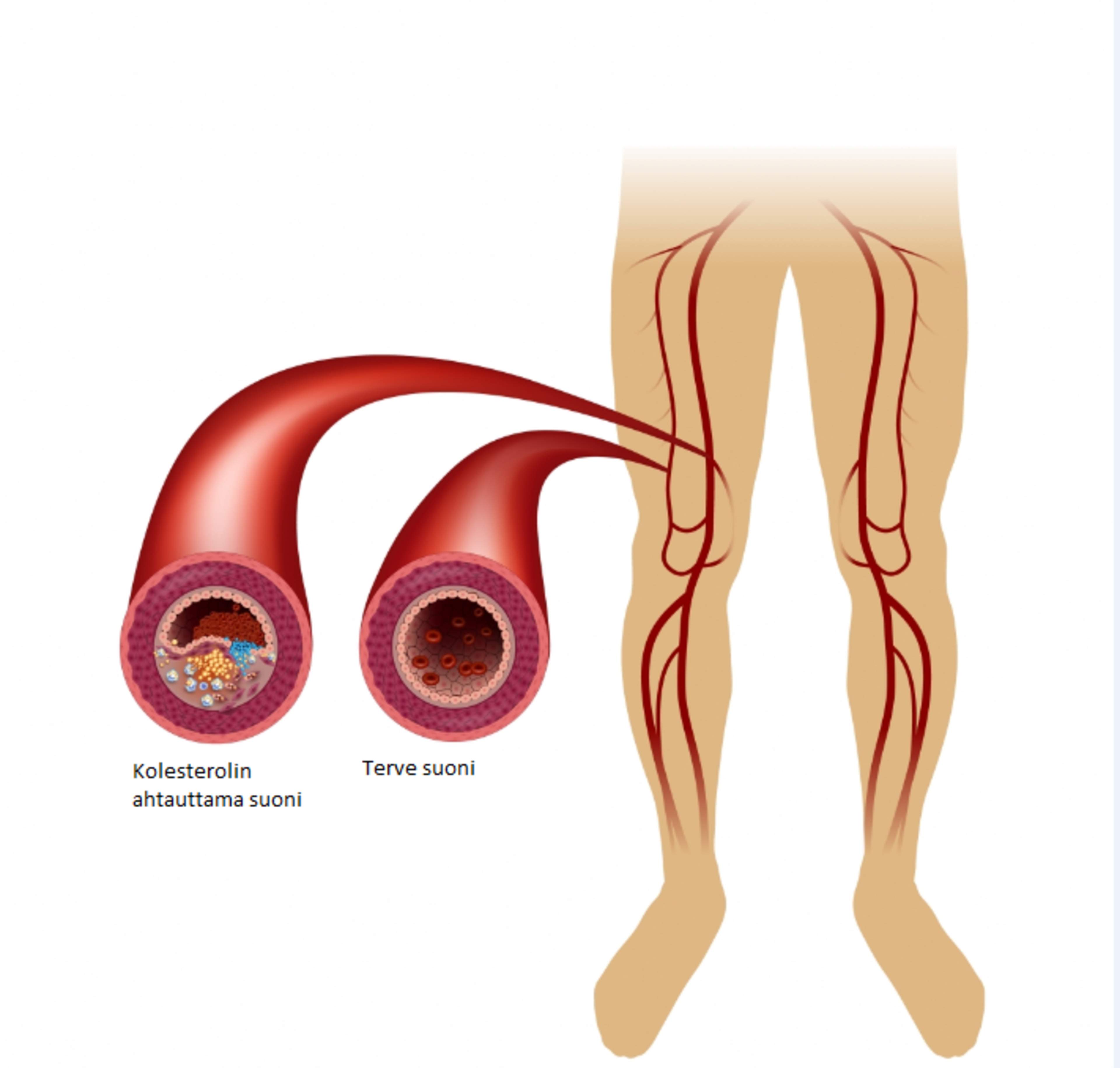 Kuvassa on kolesterolin ahtauttama verisuoni ja terve verisuoni.