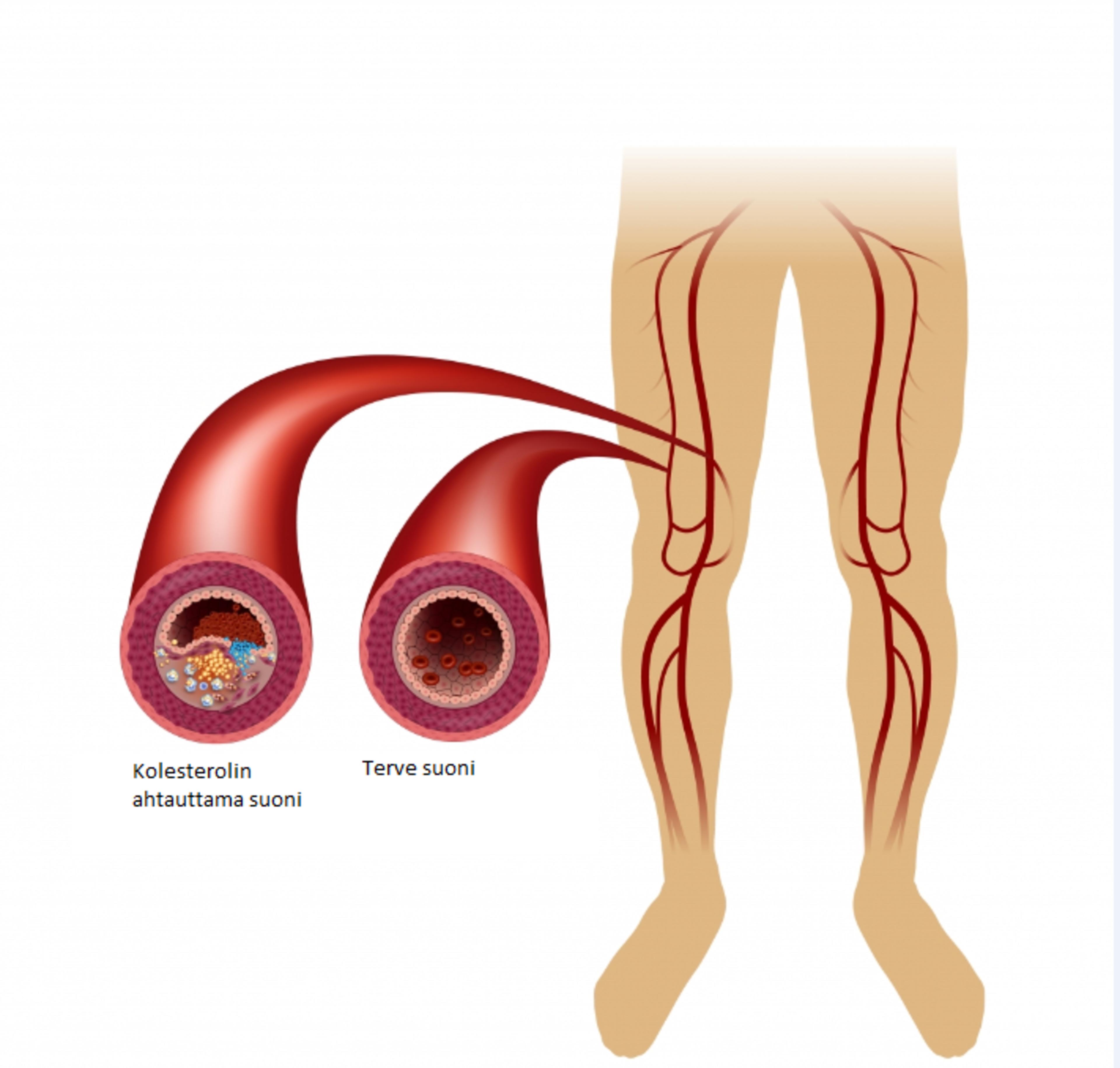 Kuvassa on kolesterolin ahtauttama verisuoni ja terve verisuoni.
