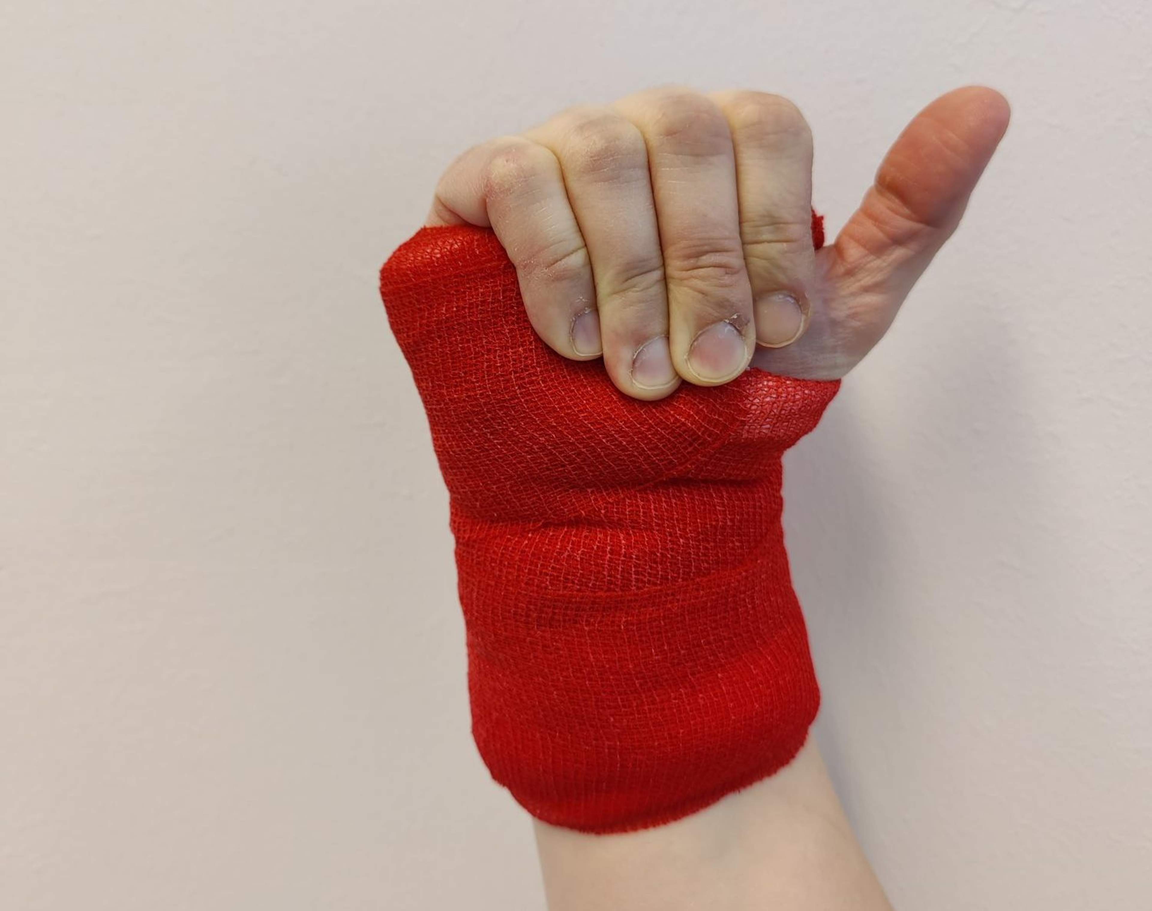Ranteessa on leikkauksen jälkeinen sidos. Sormia koukistetaan sormien kärjet suorina.