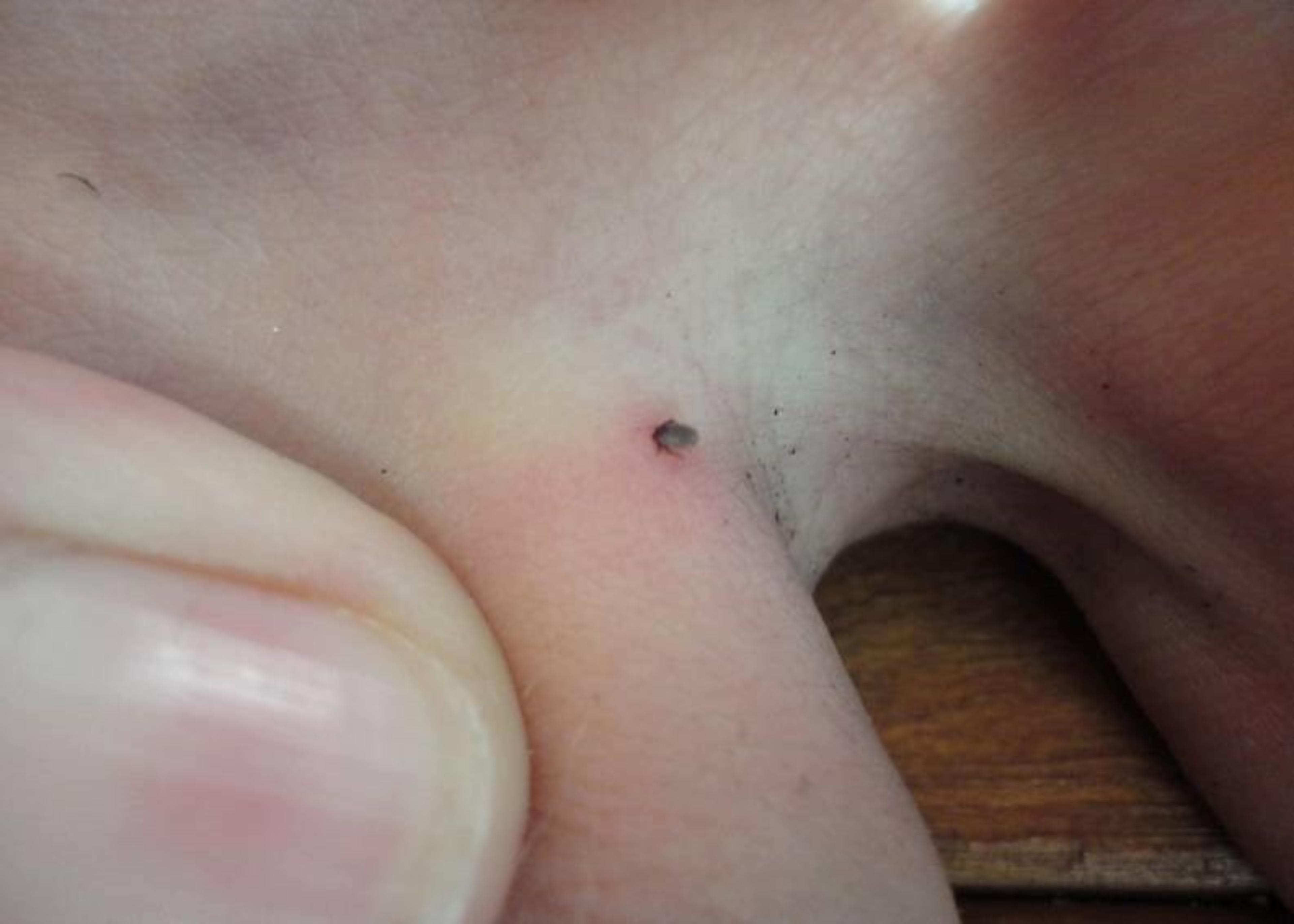 Punkki (puutiainen) aterioimassa varpaan iholla