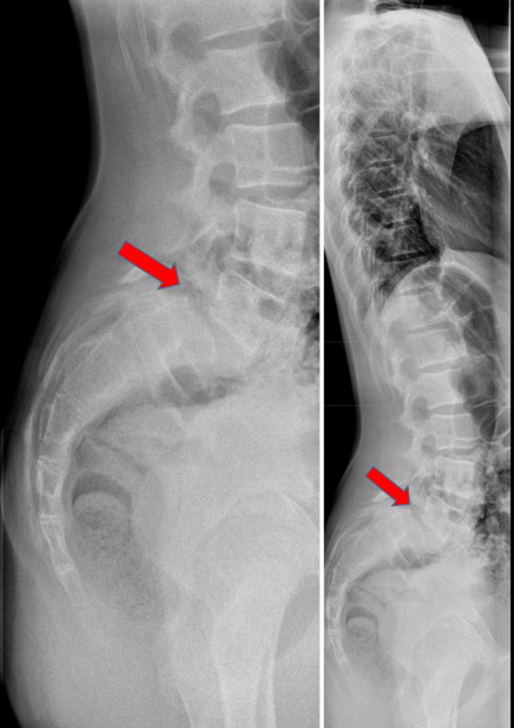 Rasitusosteopatia, spondylolyysi ja spondylolisteesi