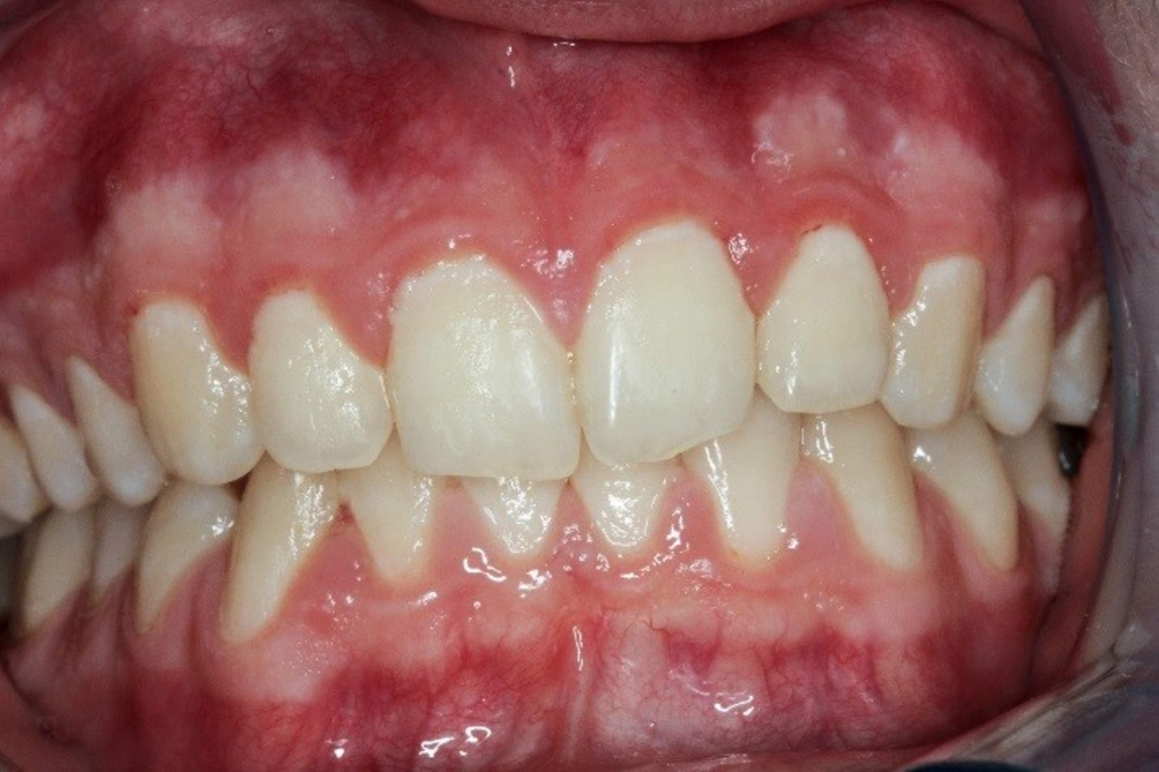 In the image is a mouth with severe gingivitis, an inflammation of the soft tissue caused by bacterial plaques throughout the entire mouth. Image: The Finnish Dental Association.