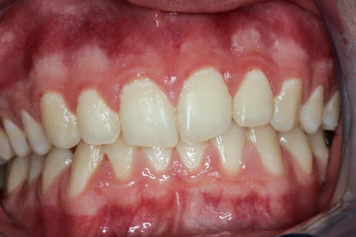 På bilden är en mun med svår gingivit, dvs. inflammation i mjukvävnaden i hela munnen orsakad av bakterietäcken. Foto: Finlands Tandläkarförbund.