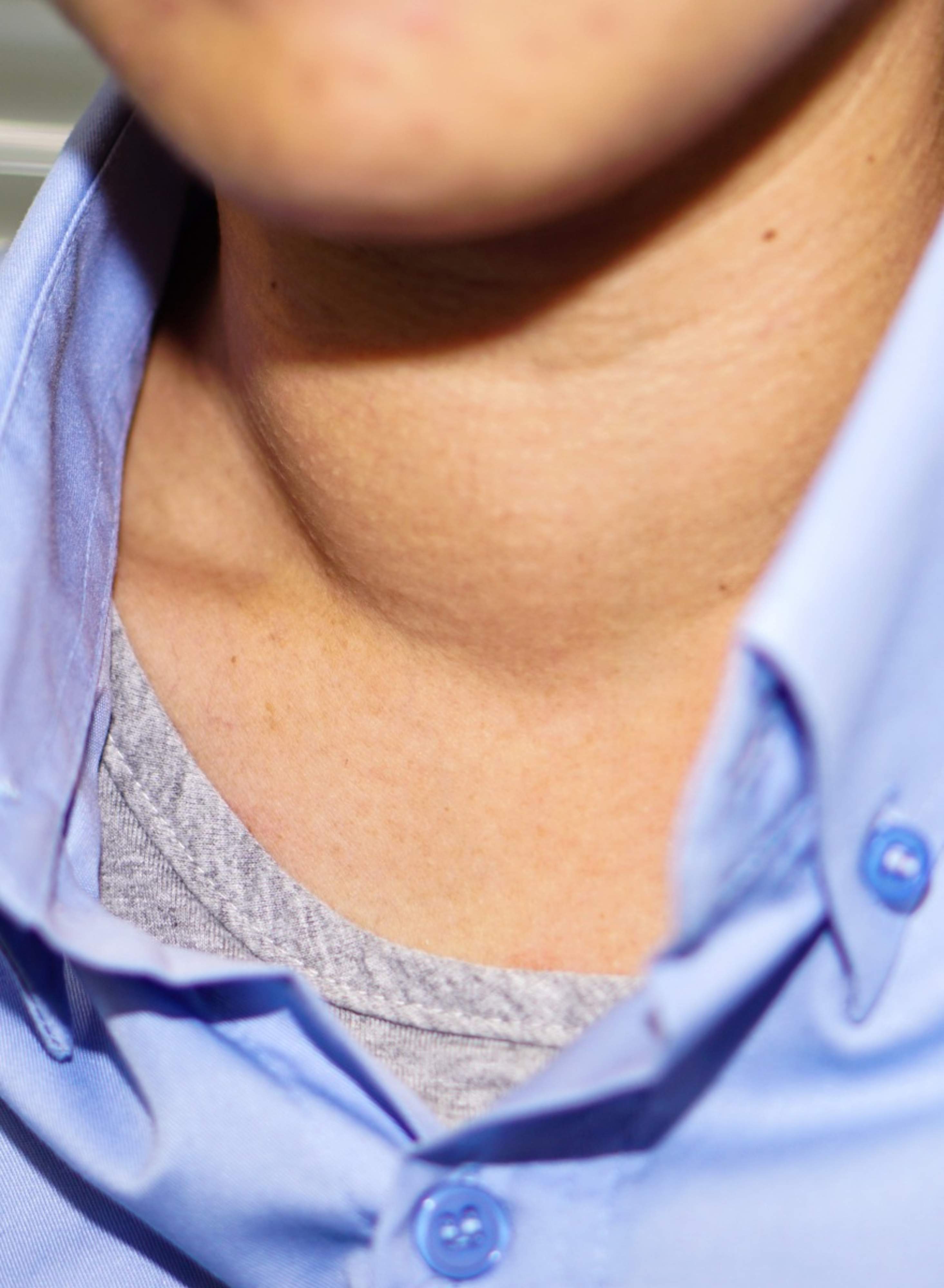 A picture of a neck with an enlargement of the thyroid visible on the right side.