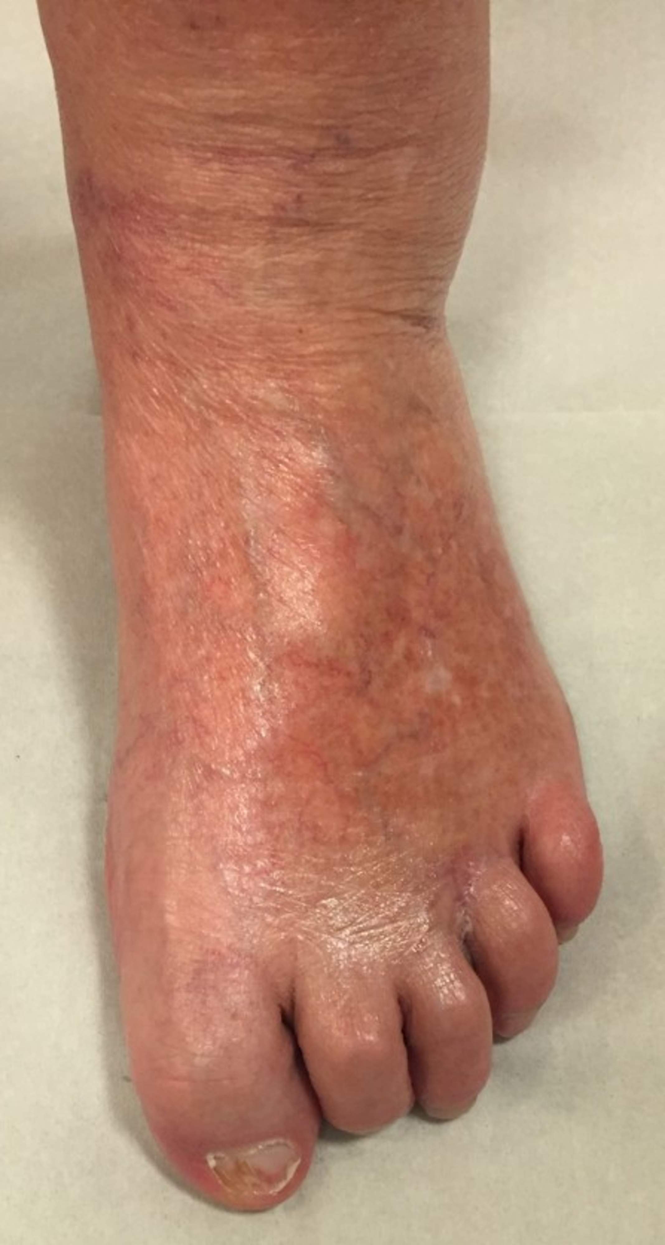 In the image, the right foot with all toes contracted into a claw-like position against the ball of the foot as hammer toes.