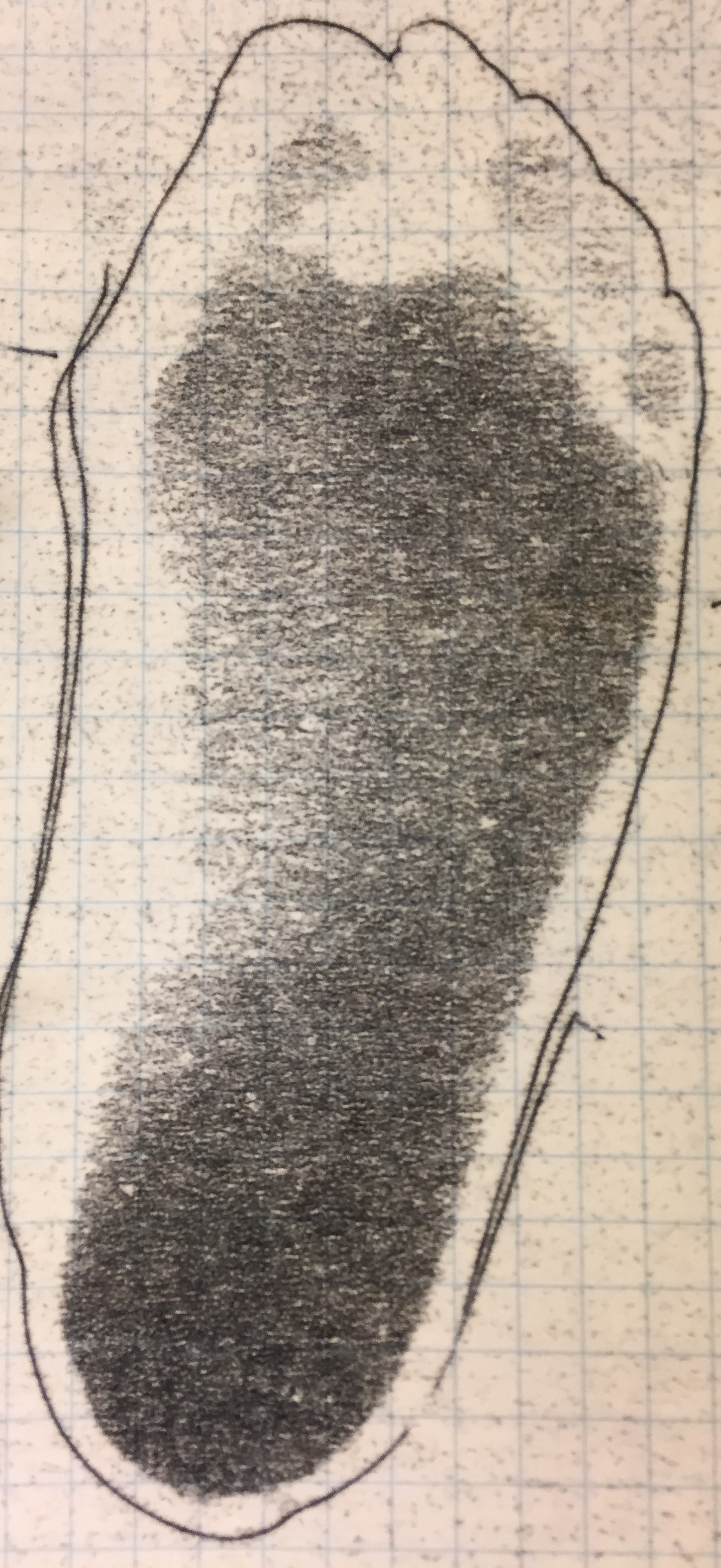 In the image is an impression pattern of a flat foot where the footprint has spread across the entire length of the foot.