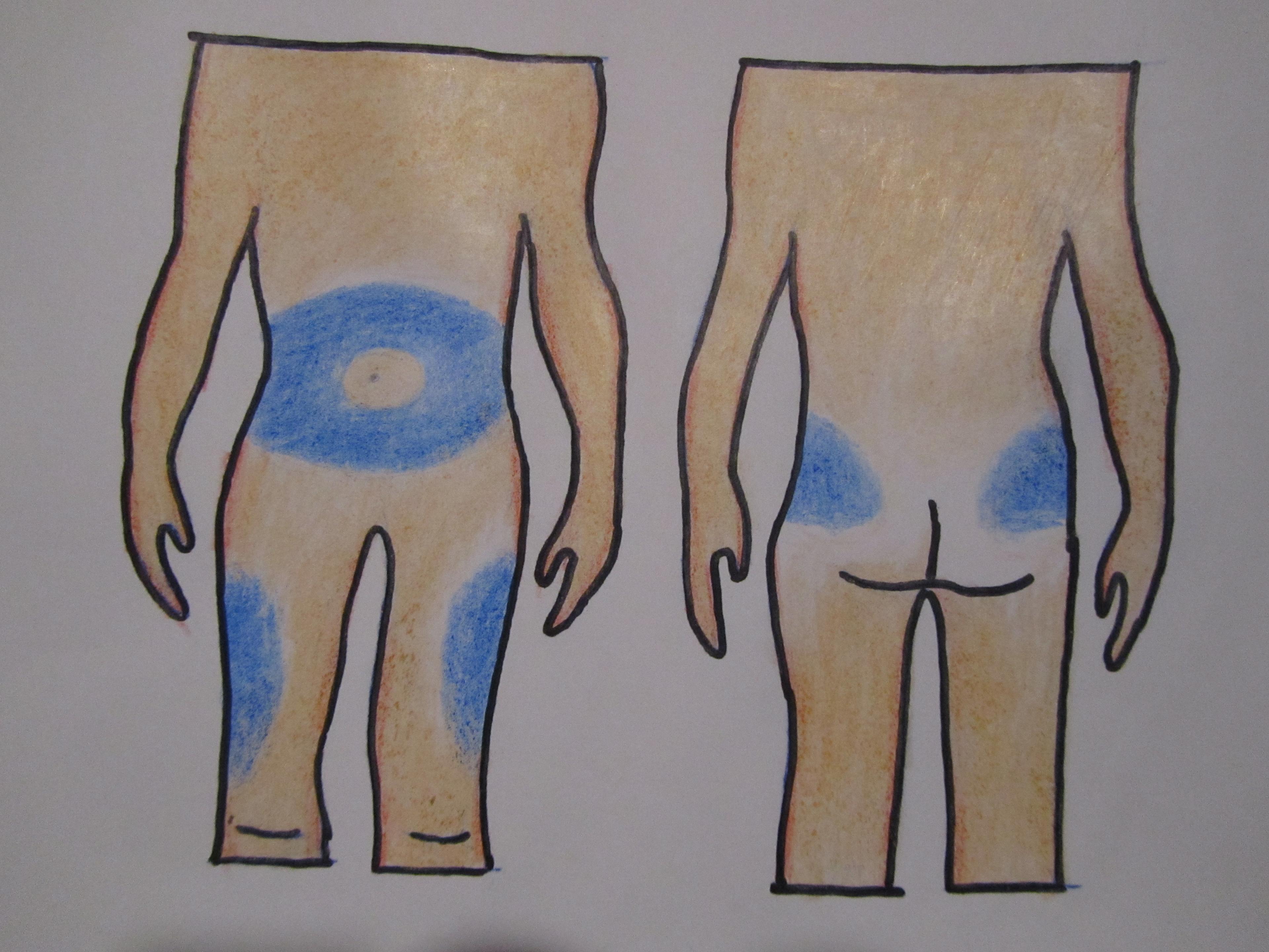 Insuliinin pistospaikkoja ovat vatsan alue ja kyljet, reisien ulkosyrjät ja pakaroiden yläosat.