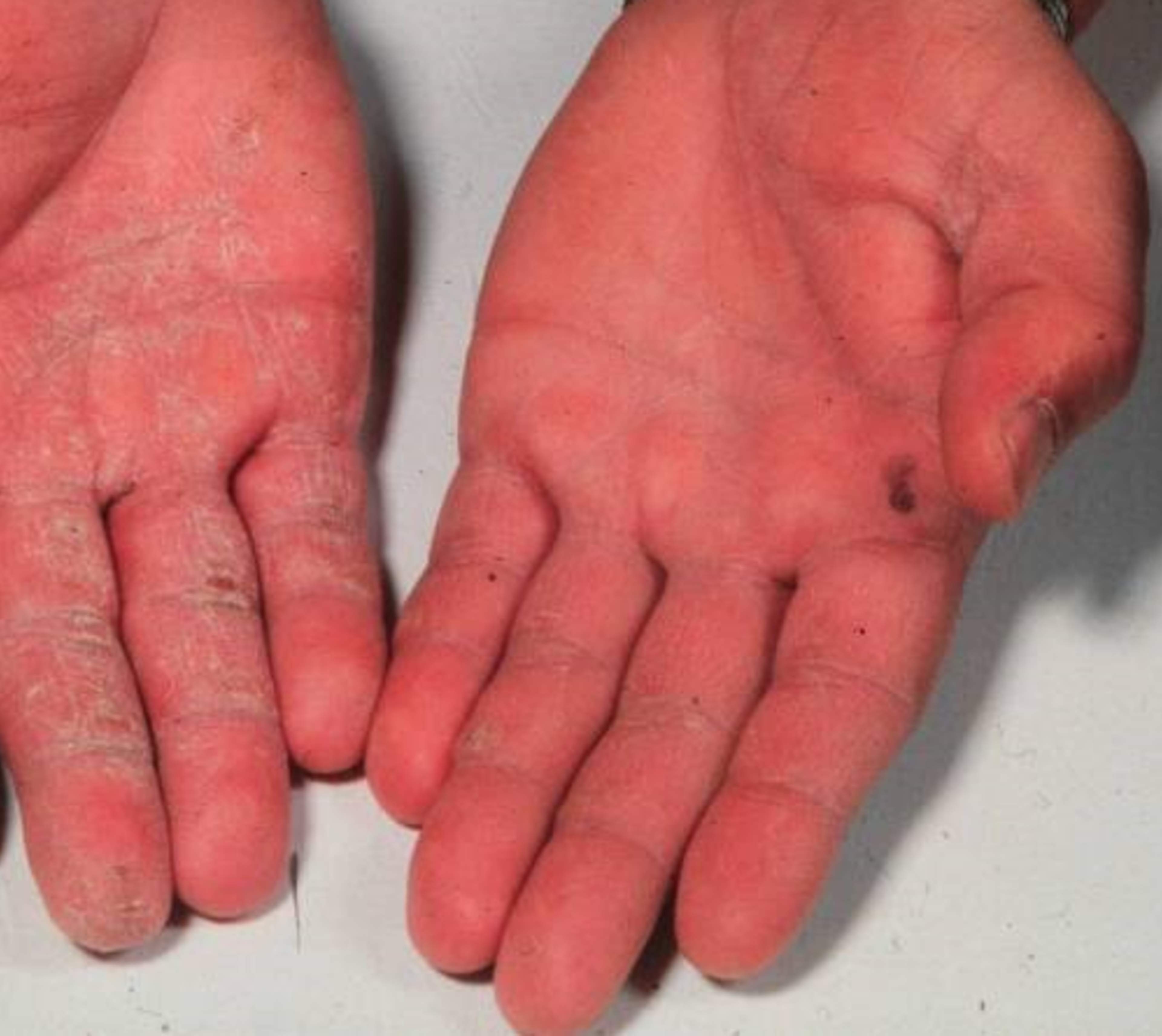 Bilden visar två händer med swampinfektion