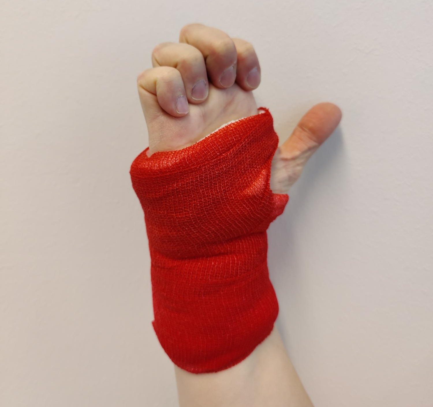 Ranteessa on leikkauksen jälkeinen sidos. Sormien kärkiniveliä koukistetaan. Rystynivelet ovat suorina.