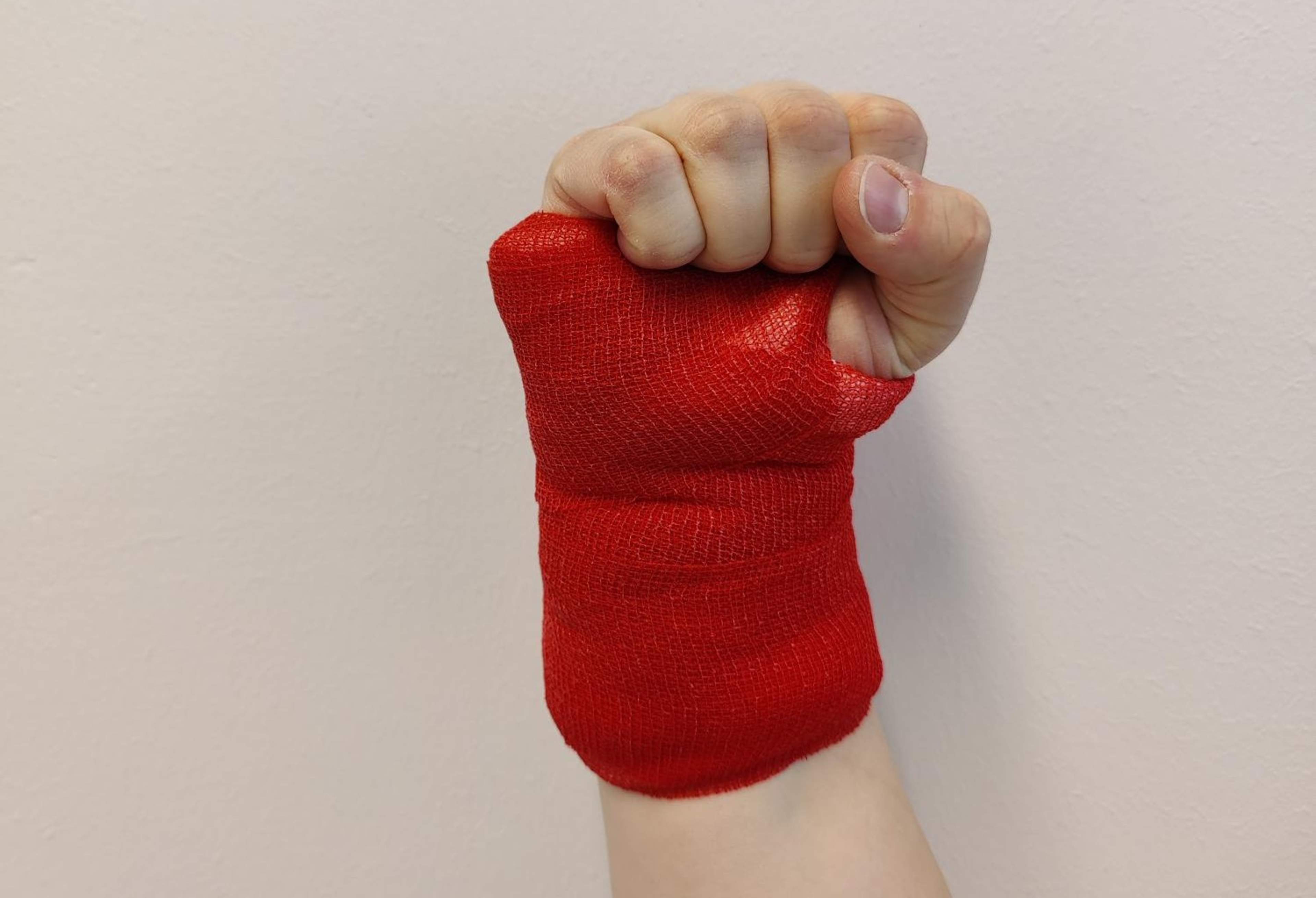 Ranteessa on leikkauksen jälkeinen sidos. Sormia koukistetaan täyteen nyrkkiin.