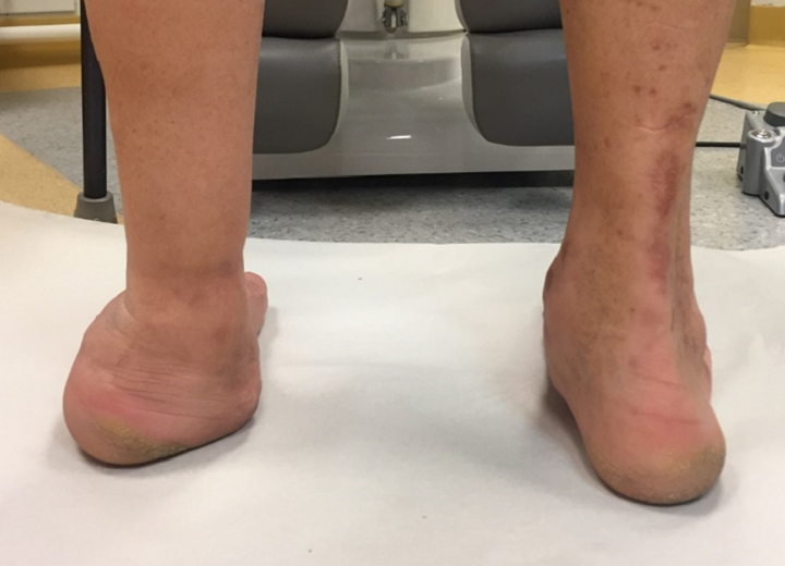 Joint disease related to diabetic nerve damage Charcot