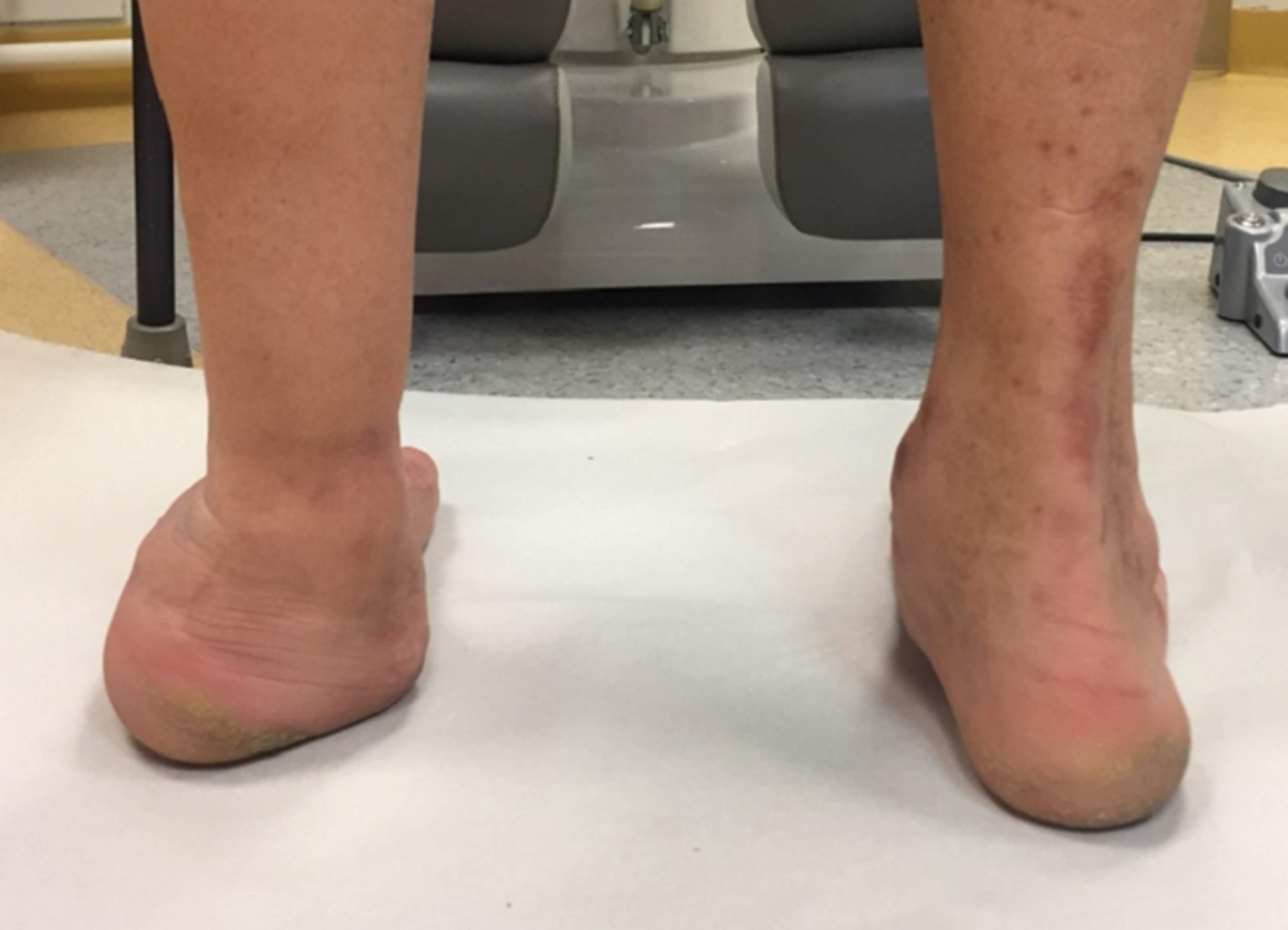 The image shows Charcot at the backside of left foot, The normal structure of the foot has spread and collapsed. image: HUS Podiatry