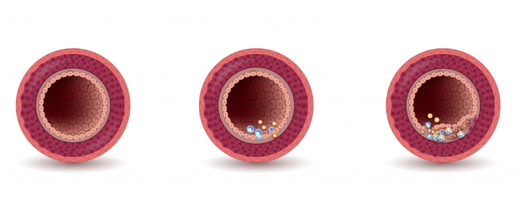 På bilden ett friskt blodkärl där alla dess tre skikt kan ses. I det mittersta och högra kärlet har det samlats kolesterol under.
