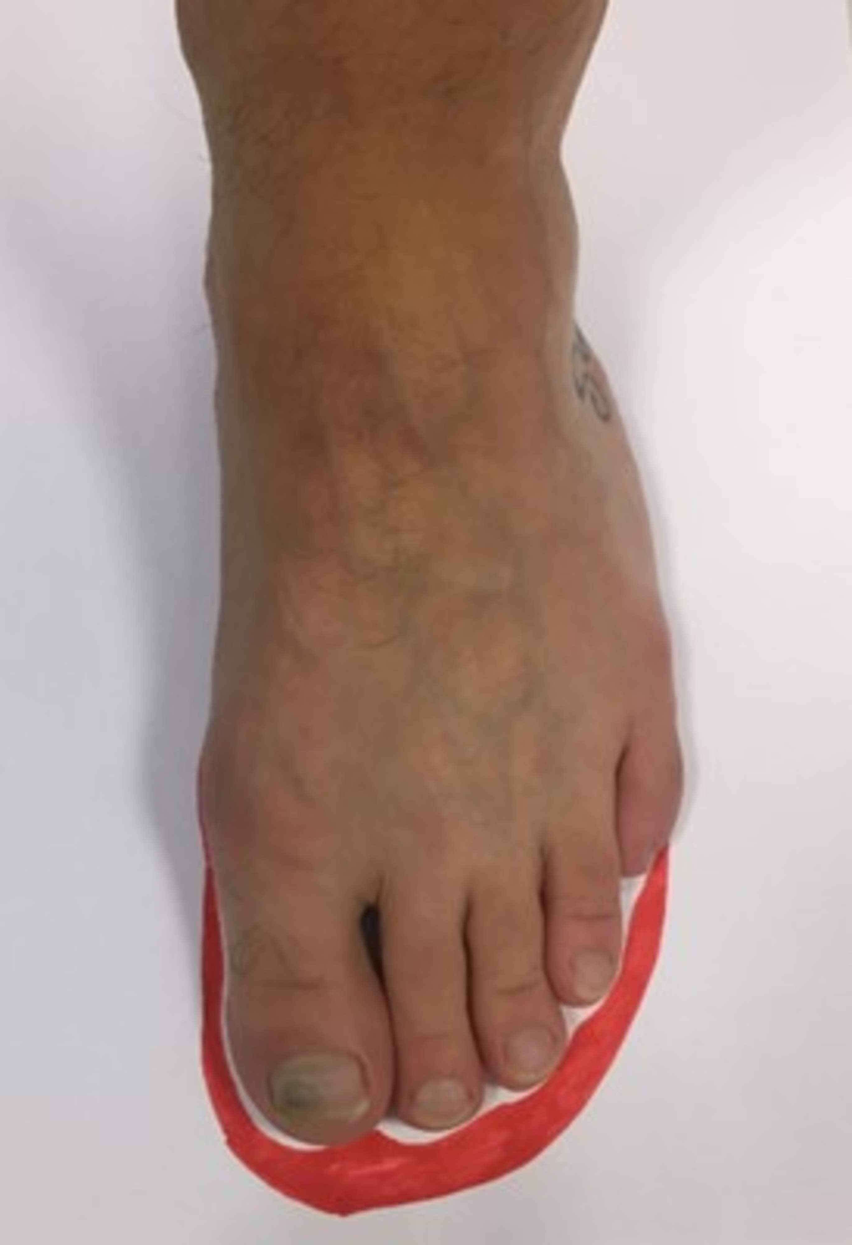 When purchasing footwear, drawing the outline of the foot's sole on cardboard can help. Allow at least 12mm of walking space.