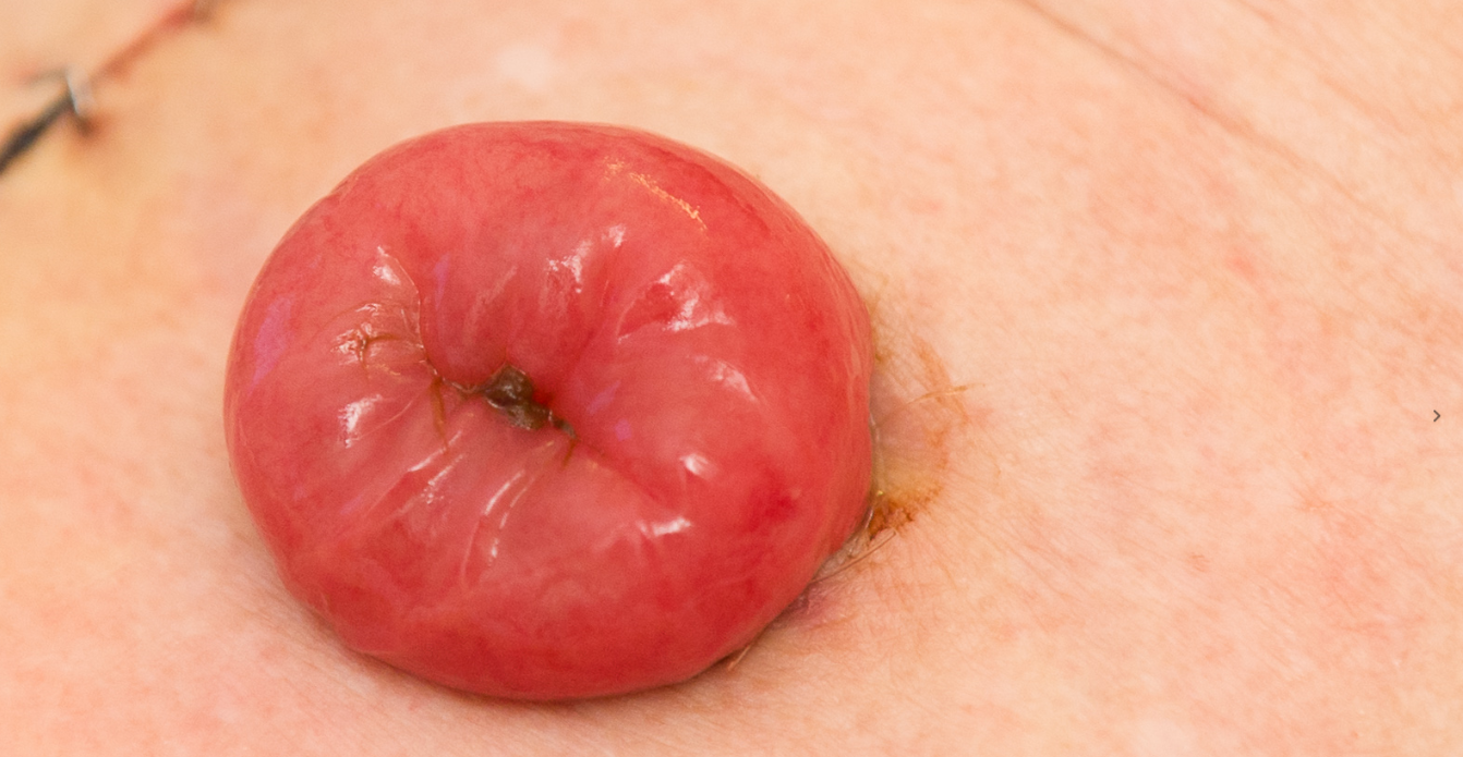 En stomi är individuell till sin form och storlek, men typiskt rund eller oval, friskt röd och fuktig på ytan.