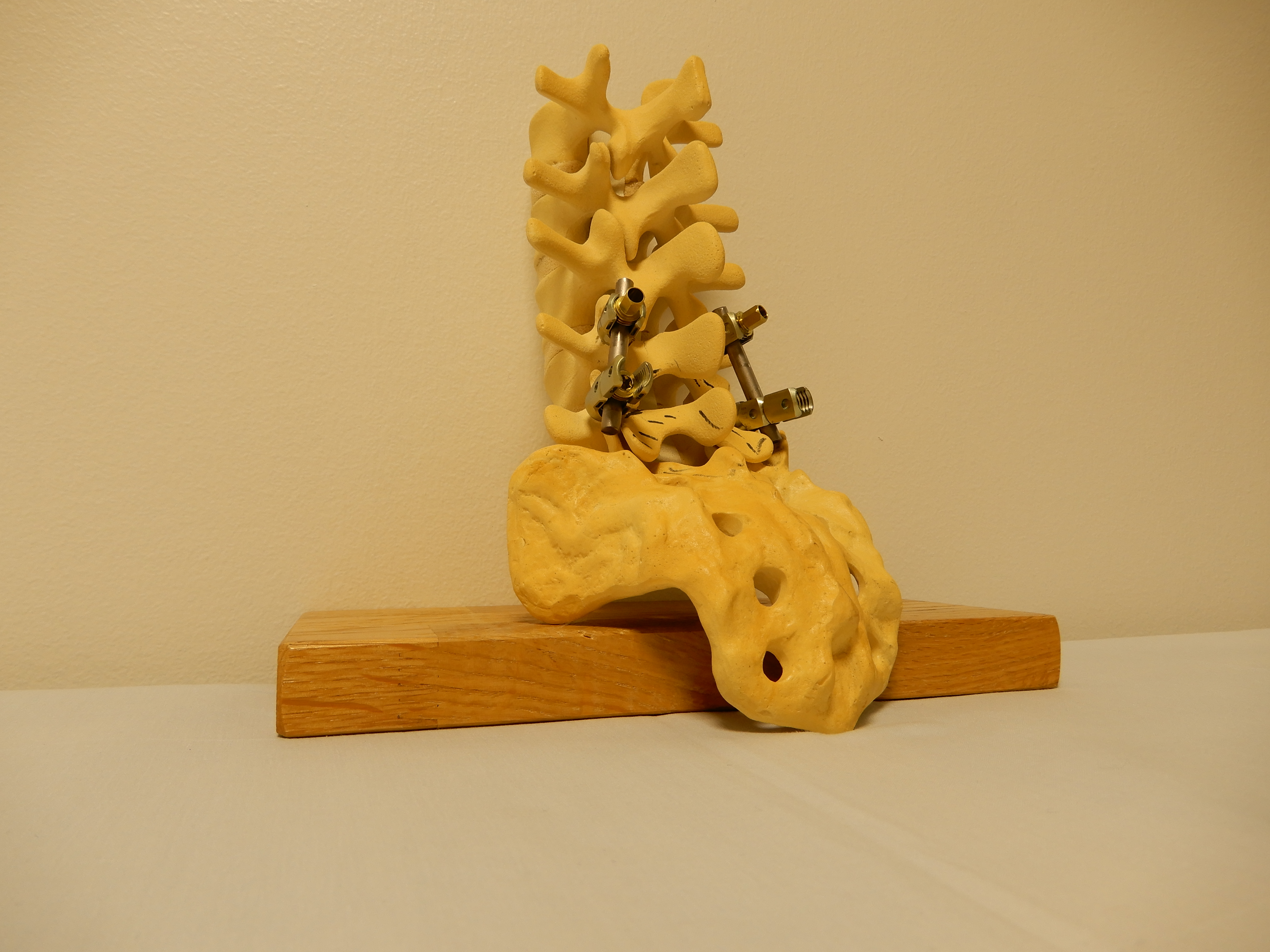 Rasitusosteopatia, spondylolyysi ja spondylolisteesi