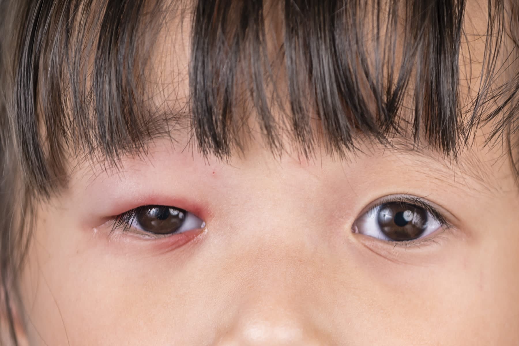 Inflammation i ögonlockskanten i det högra ögat
