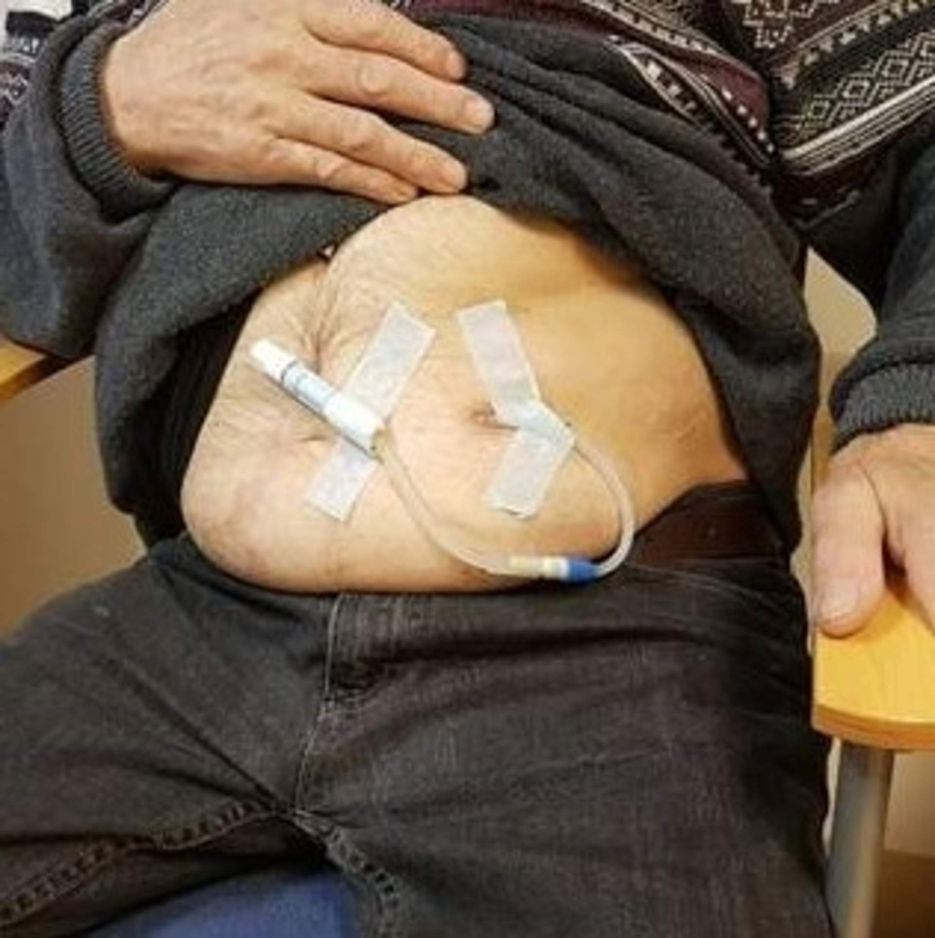Vatsakalvodialyysi vatsakalvodialyysi