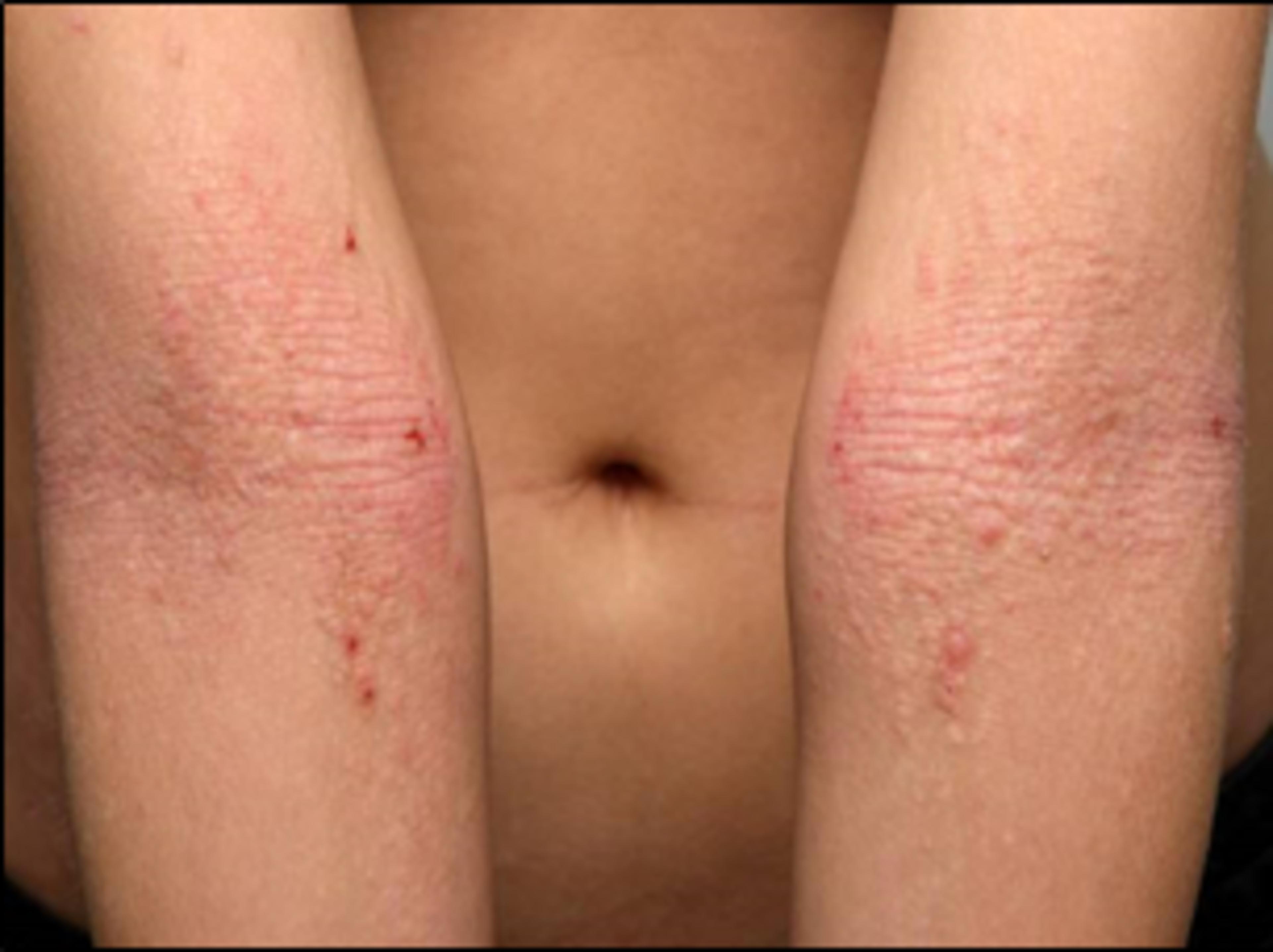 Atopiskt böjveckseksem i armbågsvecket hos vuxna.