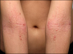 Atooppinen taiveihottuma kyynärtaipeissa aikuisella.