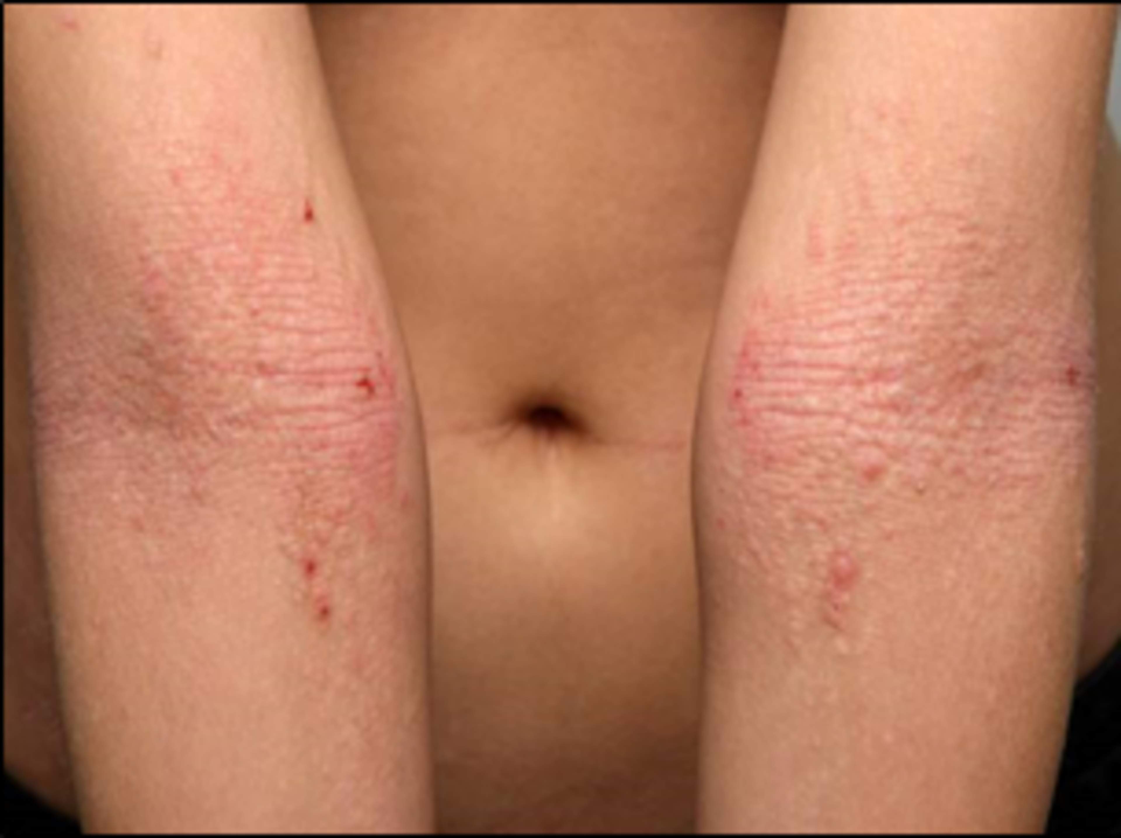 Atooppinen taiveihottuma kyynärtaipeissa aikuisella.