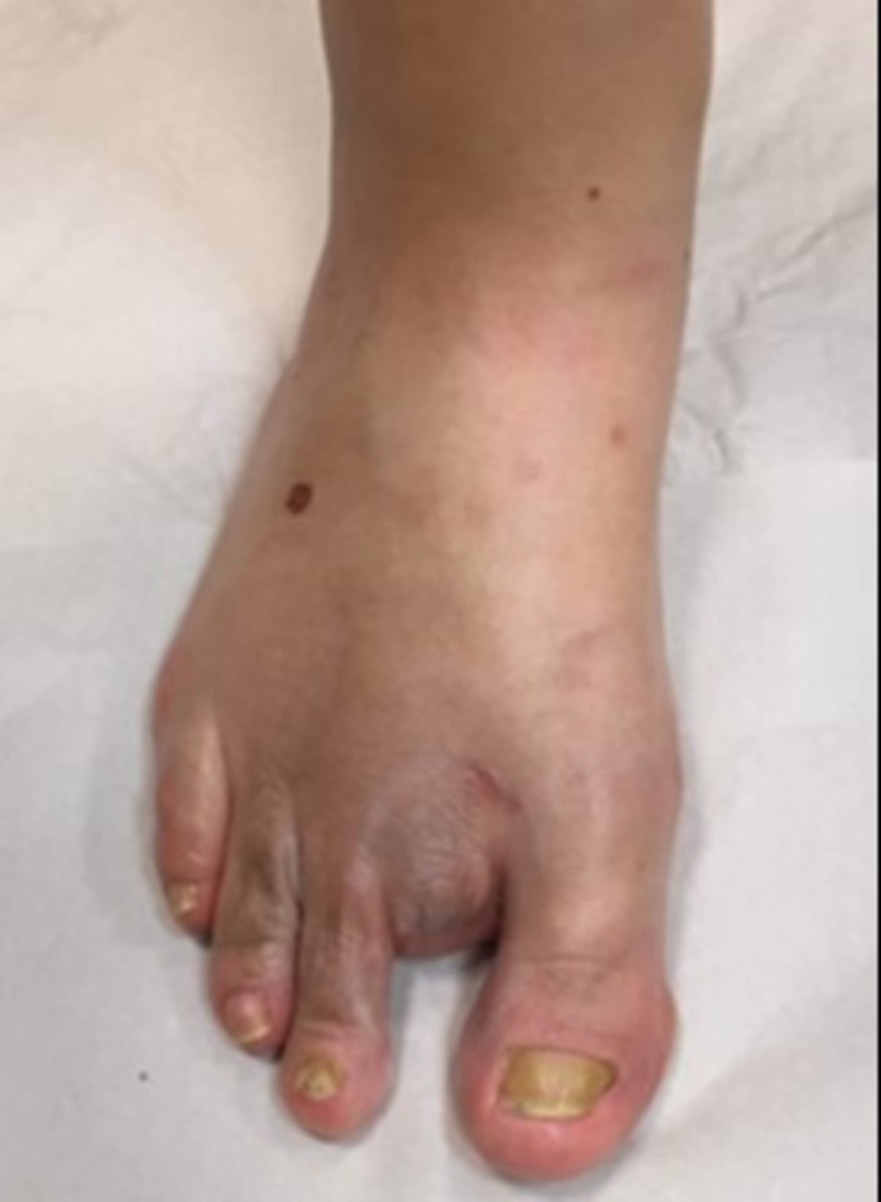 In the image, the right foot with bluish discoloration near the toes indicating impaired circulation and the toe next to the big toe amputated. The foot's risk category is 3.